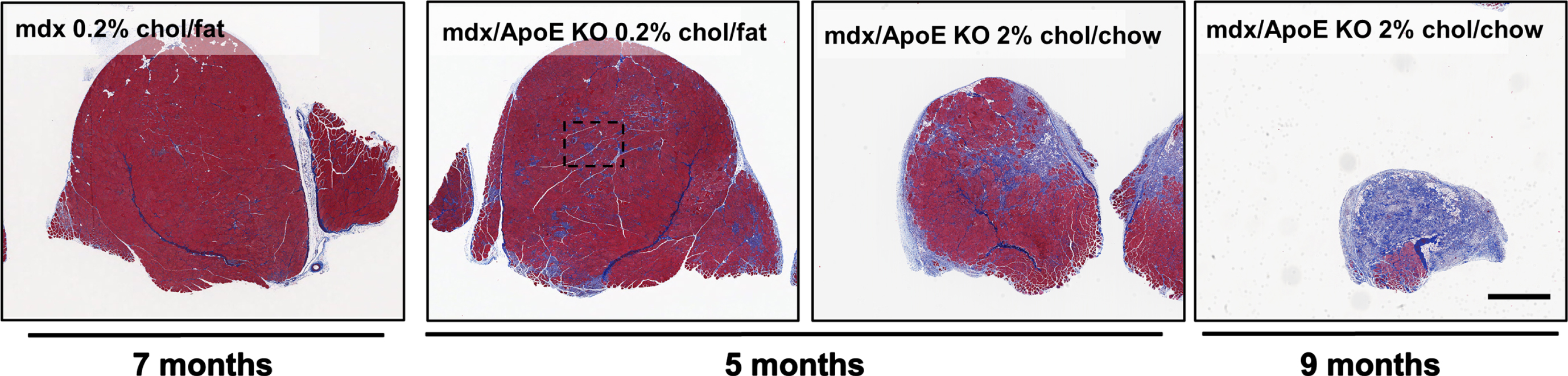 Compared with mdx mice, mdx/ApoE KO mice show evidence of severe wasting, atrophy and fiber-rich infiltration in response to dietary cholesterol supplementation. Mdx mice on an atherogenic 0.2% cholesterol, fat-based diet at 7mo of age show less muscle fibrosis and fibrofatty infiltrates than 5mo mdx/ApoE KO mice on the same diet, whereas cholesterol supplementation with a 2% cholesterol, chow-based diet further exacerbates muscle wasting at both 5 and 9mo of age, the latter resulting in humane termination due to ambulatory dysfunction. Scale bar 1 mm, all images were captured at the same magnification [32, 68].