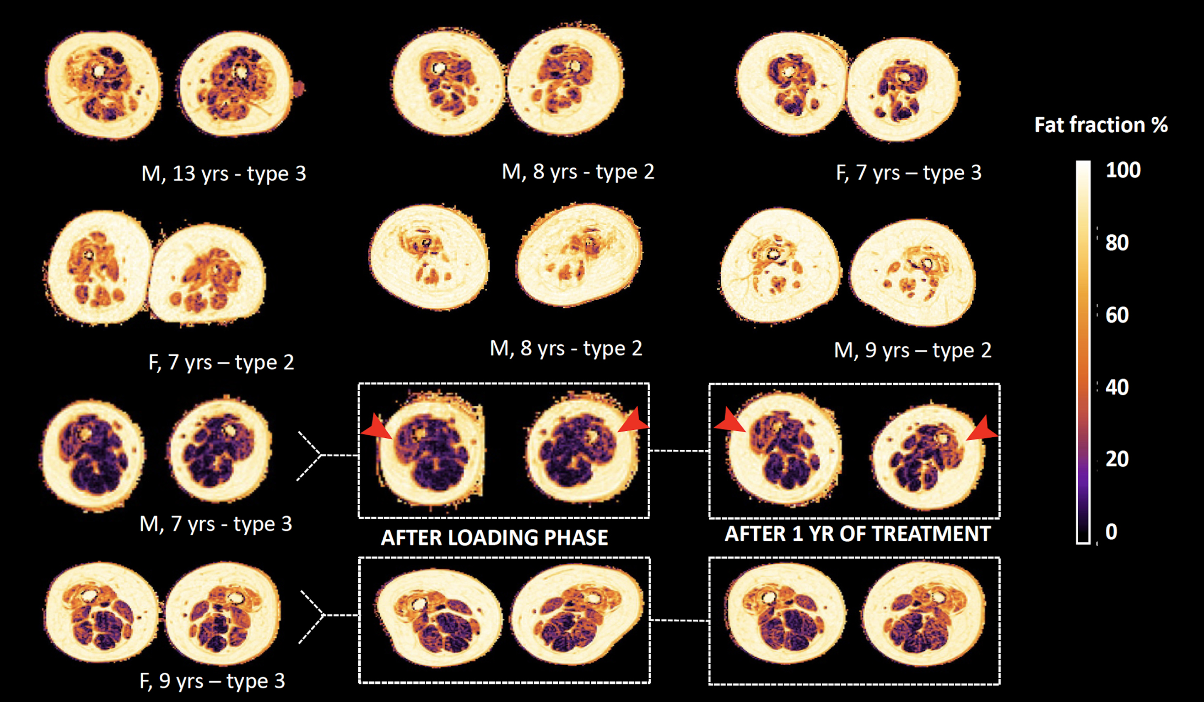 Status of fat infiltration at baseline of participants. Legend: M = male, F = female, yr(s) = year(s). Overview of the status of fat infiltration of all participants, as measured by the DIXON sequence; in the bottom two rows we highlight the three consecutive scans of two subjects. Note the visible change of color in the anterior compartment of one male subject, as indicated by the red arrows, that indicates progression of fat infiltration.
