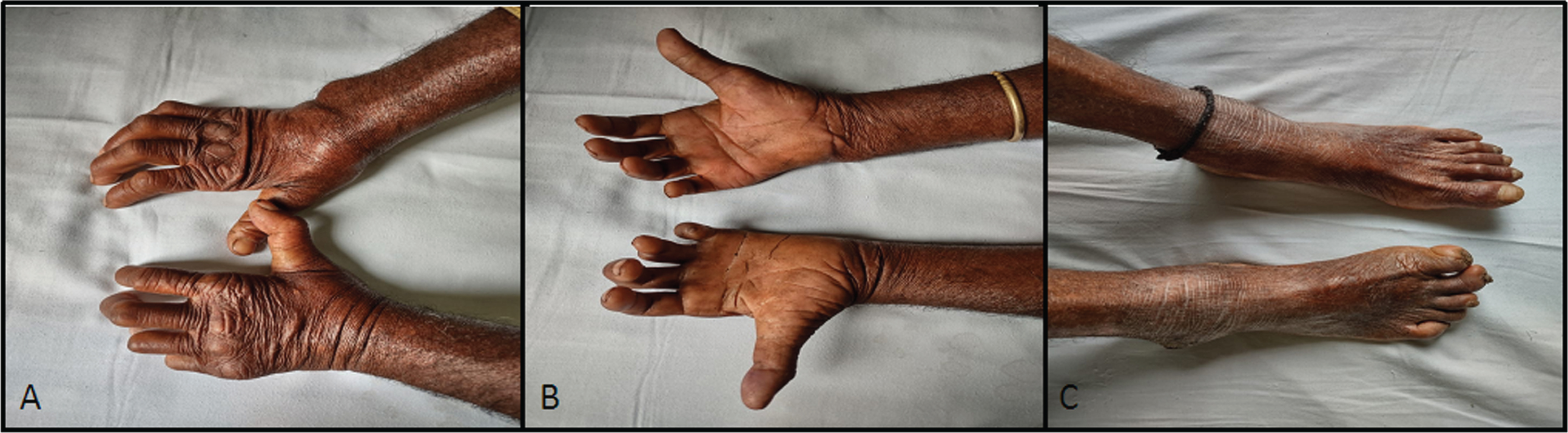 Father aged 64 years developed hand and foot deformities from adolescence which has been minimally to non-progressive. The figures show evidence of severe wasting of the hands and feet with deformities.