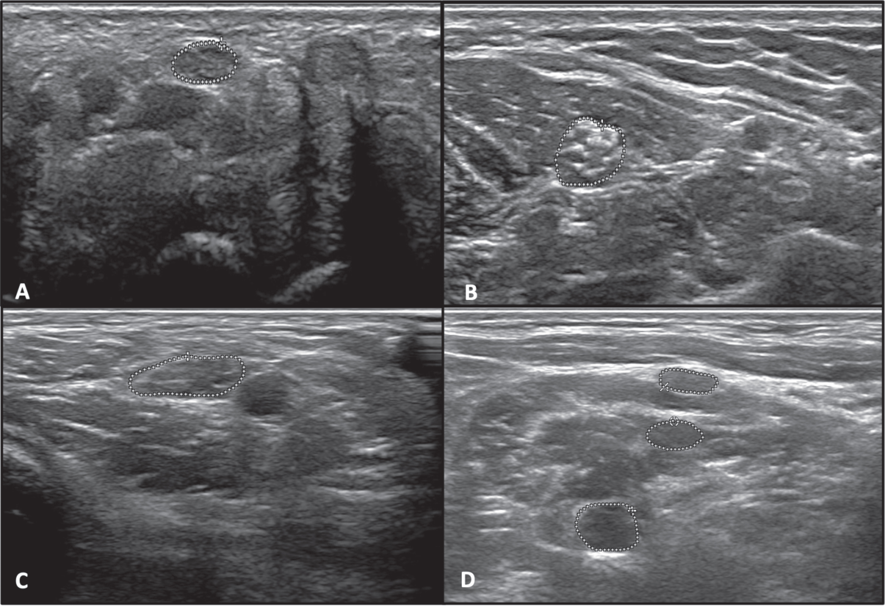 (a) Left Median nerve at the wrist(area = 8.6 mm2), (b) left Median nerve at mid-forearm between the flexor digitorum superficialis and flexor digitorum profundus (area = 18.2 mm2), (c) Left Median nerve at the elbow medial to the brachial artery (area = 20.8 mm2), (d) Left Brachial plexus upper (area = 16.1 mm2), middle (area = 6.8 mm2), and lower trunk (area = 8.0 mm2).