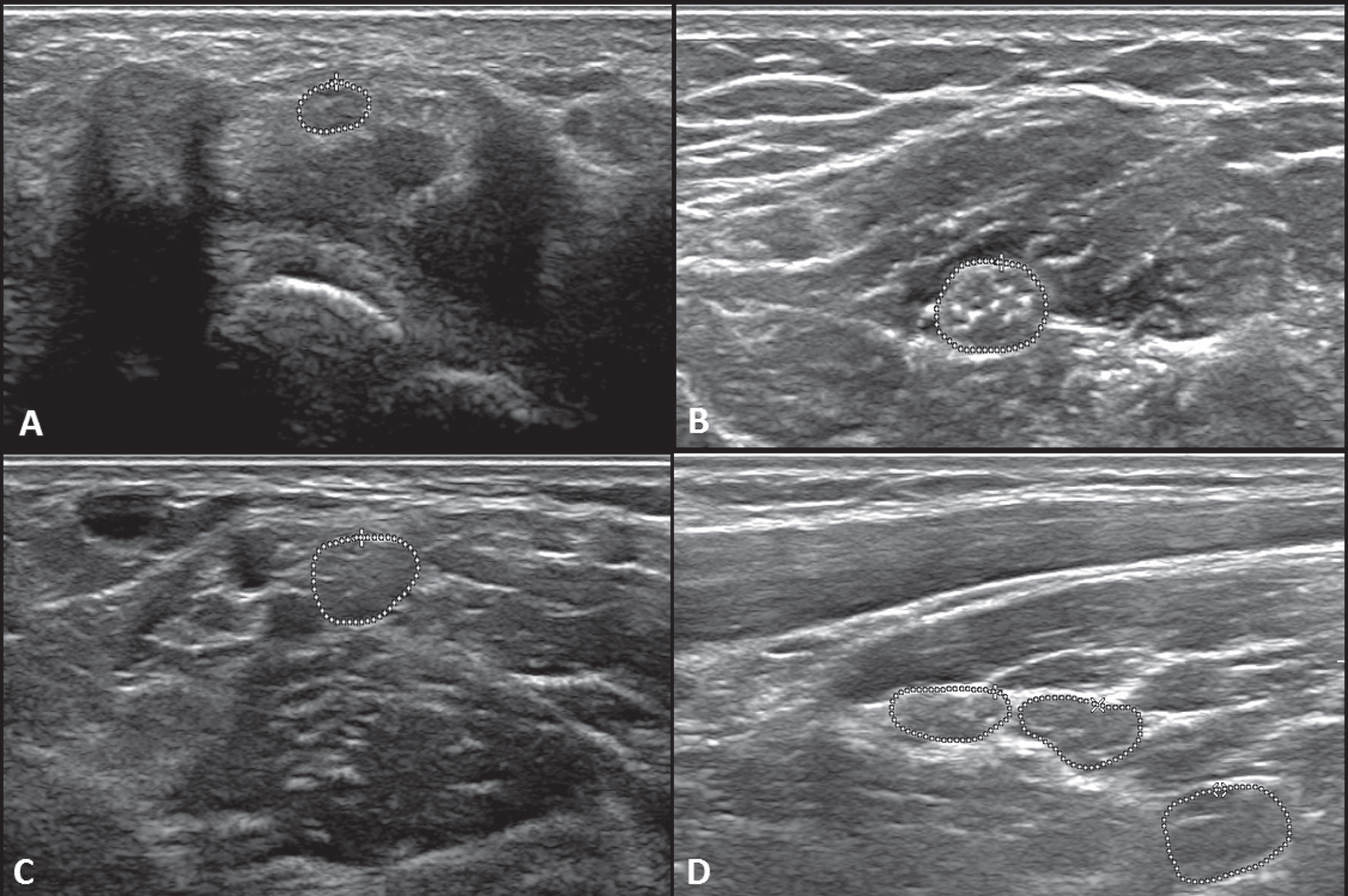 Ultrasound cross-section images of the median and ulnar nerves. Fig 2.1 (a) Right Median nerve at the wrist (area = 5.9 mm2), (b) Right Median nerve at mid-forearm between the flexor digitorum superficialis and flexor digitorum profundus (area = 17.8 mm2), (c) Right Median nerve at the elbow medial to the brachial artery (area = 15.6 mm2), (d) Right Brachial plexus upper (area = 14.2 mm2), middle (area = 16.9 mm2), and lower truck (area = 25.7 mm2).