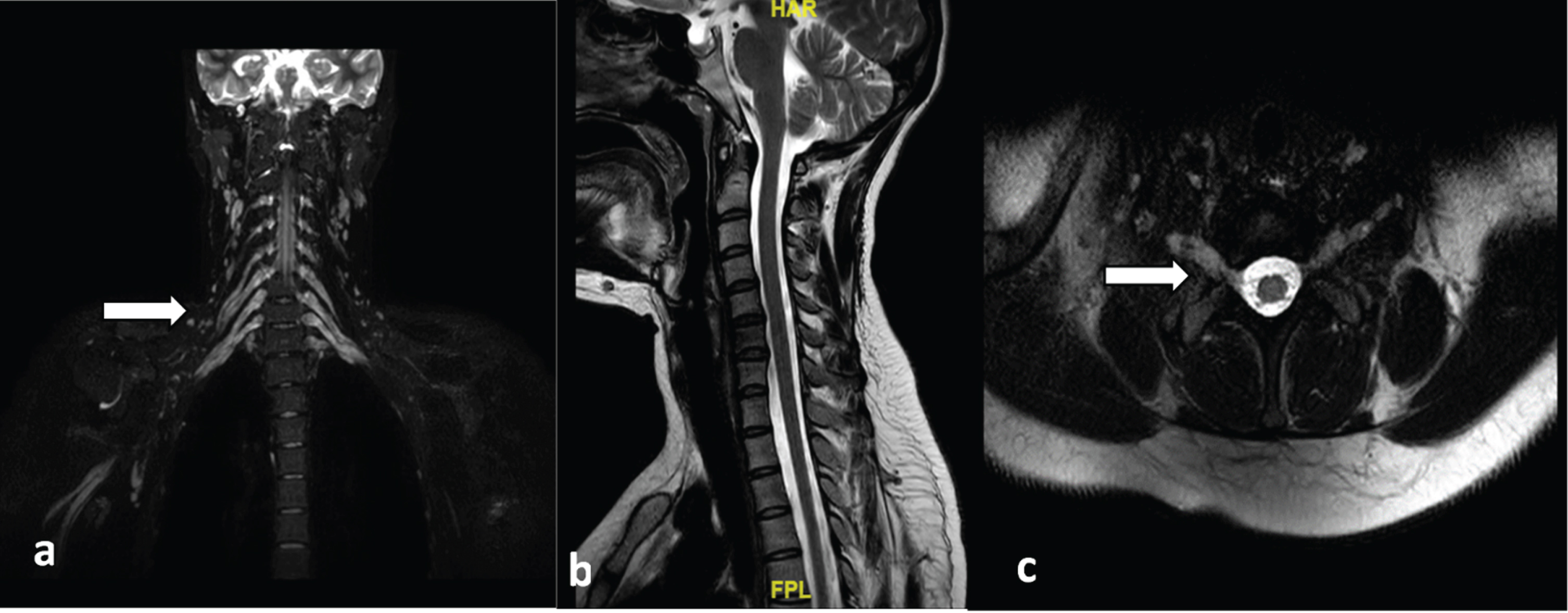 MRI of the Brachial plexus. (a,c) Near symmetric thickening with T2 hyperintense signal of the roots, trunks, divisions, and cords of the bilateral brachial plexii (arrows), (b) T2W image of the sagittal section showing normal spinal cord. (MRI, Magnetic resonance imaging).