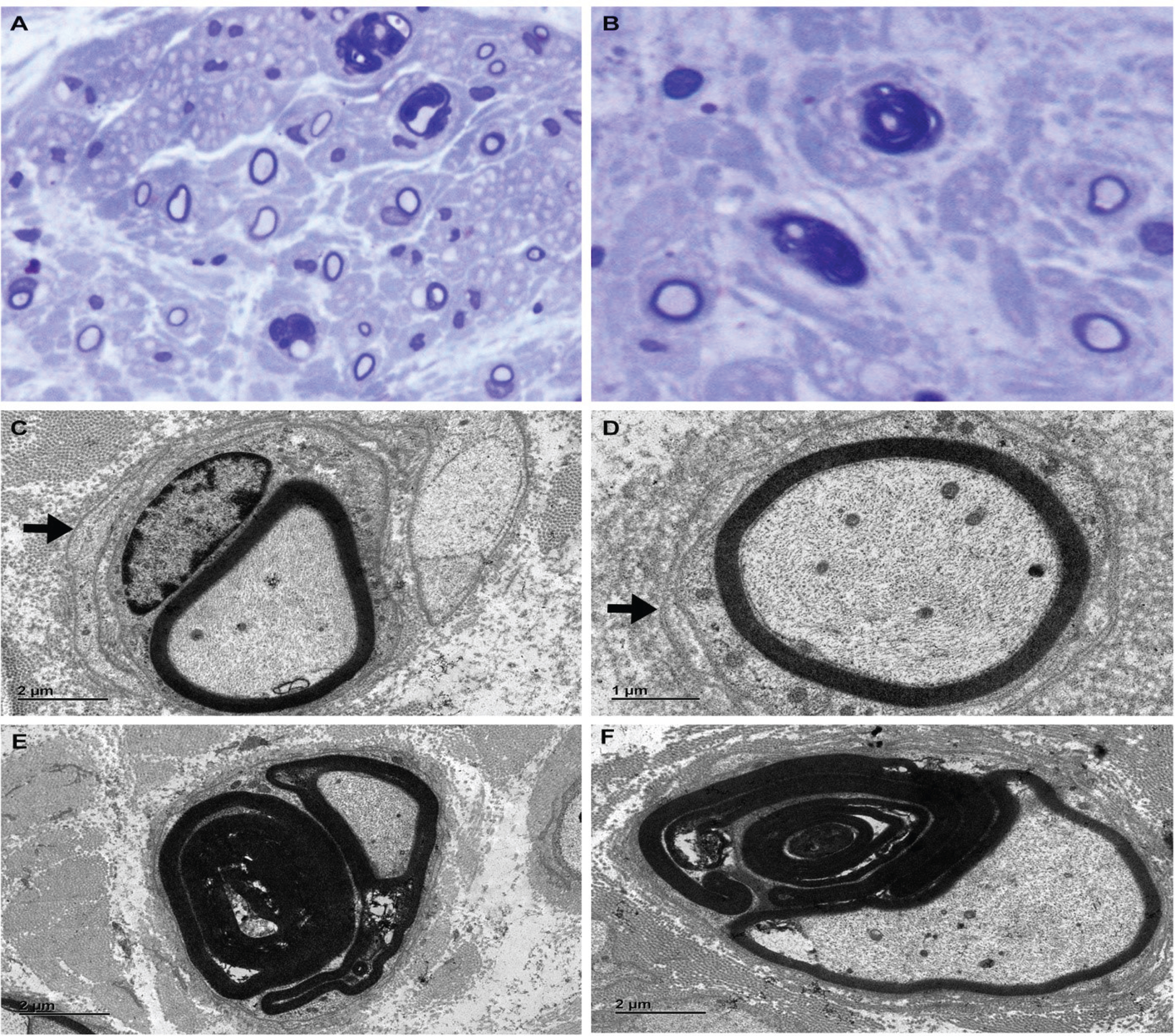 Nerve biopsy: (A) and (B) Semithin sections of resin embedded tissue stained with toluidine blue show severe and fairly uniform depletion of myelinated fibers, thin myelin sheaths, occasional onion bulbs, and fibers with abnormal myelin folds (A ×200, B ×400). (C) and (D) Electron micrography- Ultrathin sections stained with uranyl acetate and lead citrate reveal thinly myelinated fibers with Schwann cell lamellae (arrow) indicating early onion bulb formation [C ×2000; D, ×4000]. (E) and (F) Fibers with numerous thick abnormal myelin folds forming redundant outpouchings and infoldings [E & F, ×2000].
