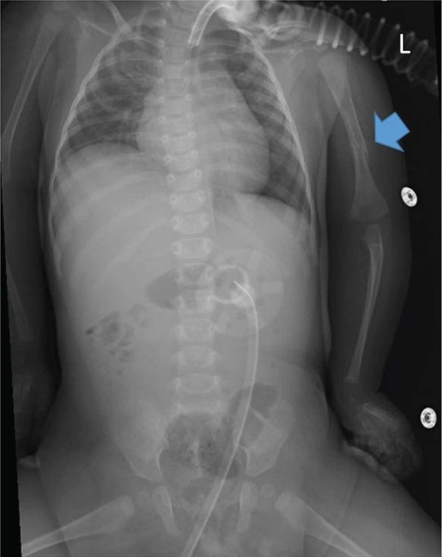 Chest X-ray of patient #1 at 3 months of life showing a diaphyseal fracture on the left humerus, with signs of bone callus apposition (blue arrow). L = left.