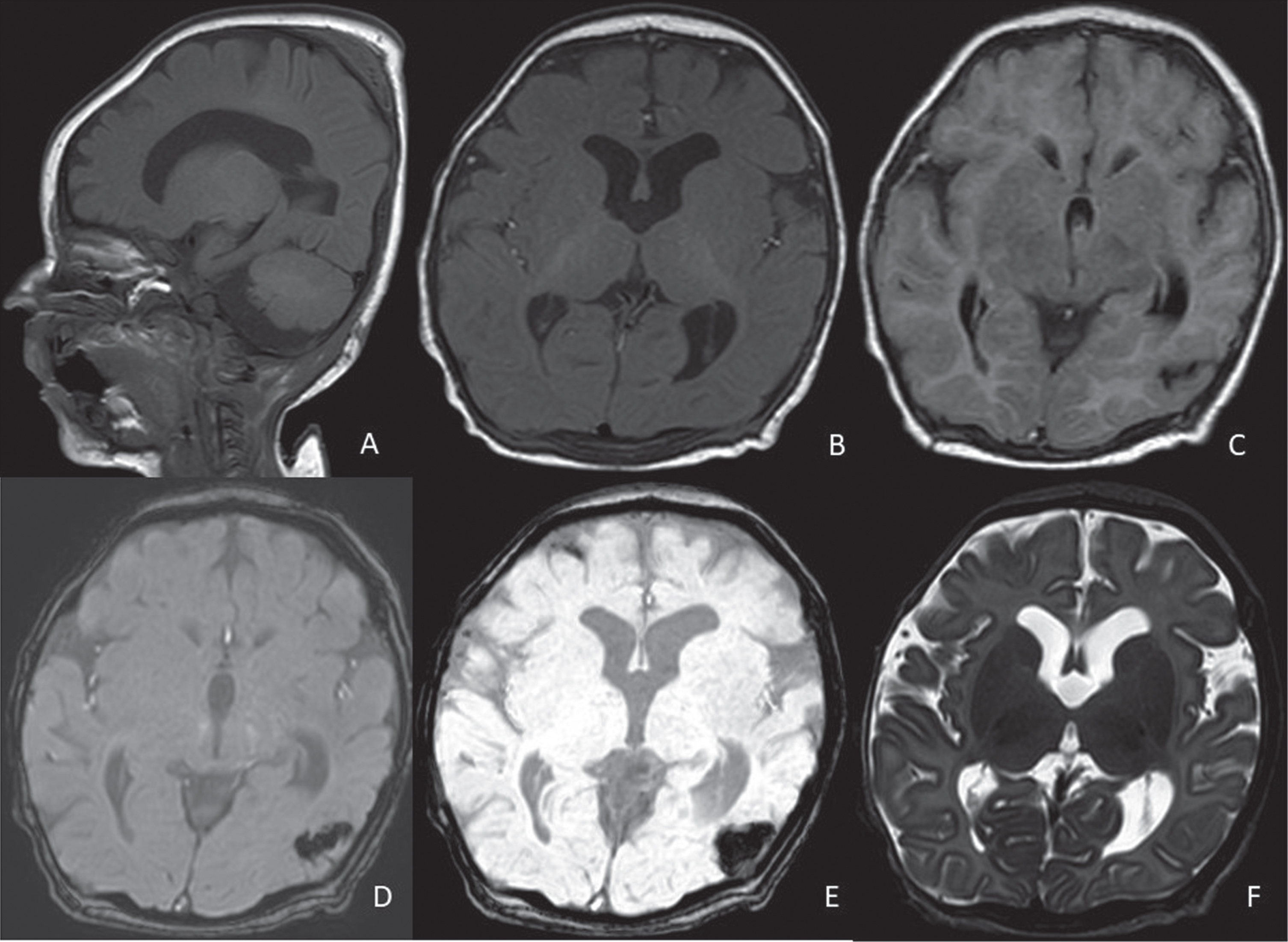 Control brain MRI of patient #1 at 3 months of age. Dilated ventricualr system (especially at the lateral ventricles level, A-F), increased CSF spaces in the rolandic areas bilaterally, chronic evolution of a focal haemorrhage at the left temporo-occipital carrefour. A: sagittal T1, B: axial T1, C: axial FLAIR, D: axial susceptibility-weighted phase (SWIp) fast, E: axial minimum intensity projection (miniP), F: axial T2-weighted sequence.