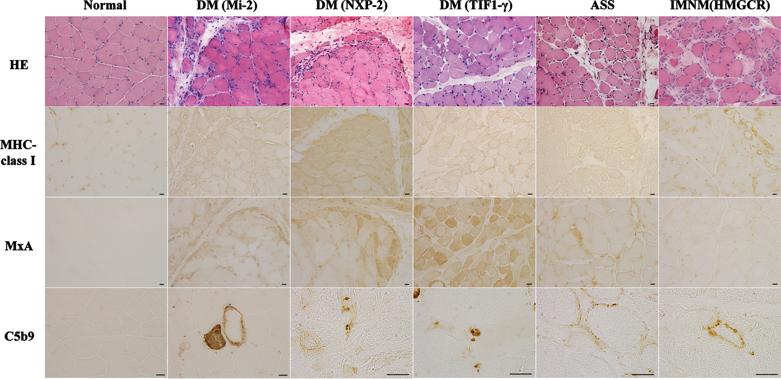 Represent muscle biopsy findings in different idiopathic inflammatory myopathies subtypes based on antibody subtypes. Hemotoxylin and eosin (HE) staining shows perifascicular necrosis and atrophy in anti-Mi-2 dermatomyositis (DM) and anti-NXP2 DM, perifascicular atrophy and vacuolated punched-out fibers in anti-TIF1-γ DM, myofiber necrosis and regeneration in anti-synthetase syndrome (ASS) and immune-mediated necrotizing myopathy (IMNM). Positivity of HLA-ABC immunostaining is observed in anti-Mi-2 DM, anti-NXP2 DM, anti-TIF1-γ DM, ASS and IMNM. Sarcoplasmic Myxovirus Resistance Protein A (MxA) positivity in perifascicular is observed in anti-Mi-2 DM, anti-NXP2 DM and anti-TIF1-γ DM. Deposition of C5b9 is present in capillaries in anti-NXP2 DM and anti-TIF1-γ DM and in muscle fiber membrane in anti-Mi-2 DM, ASS and anti-HMGCR IMNM. Scale bar = 20μm.