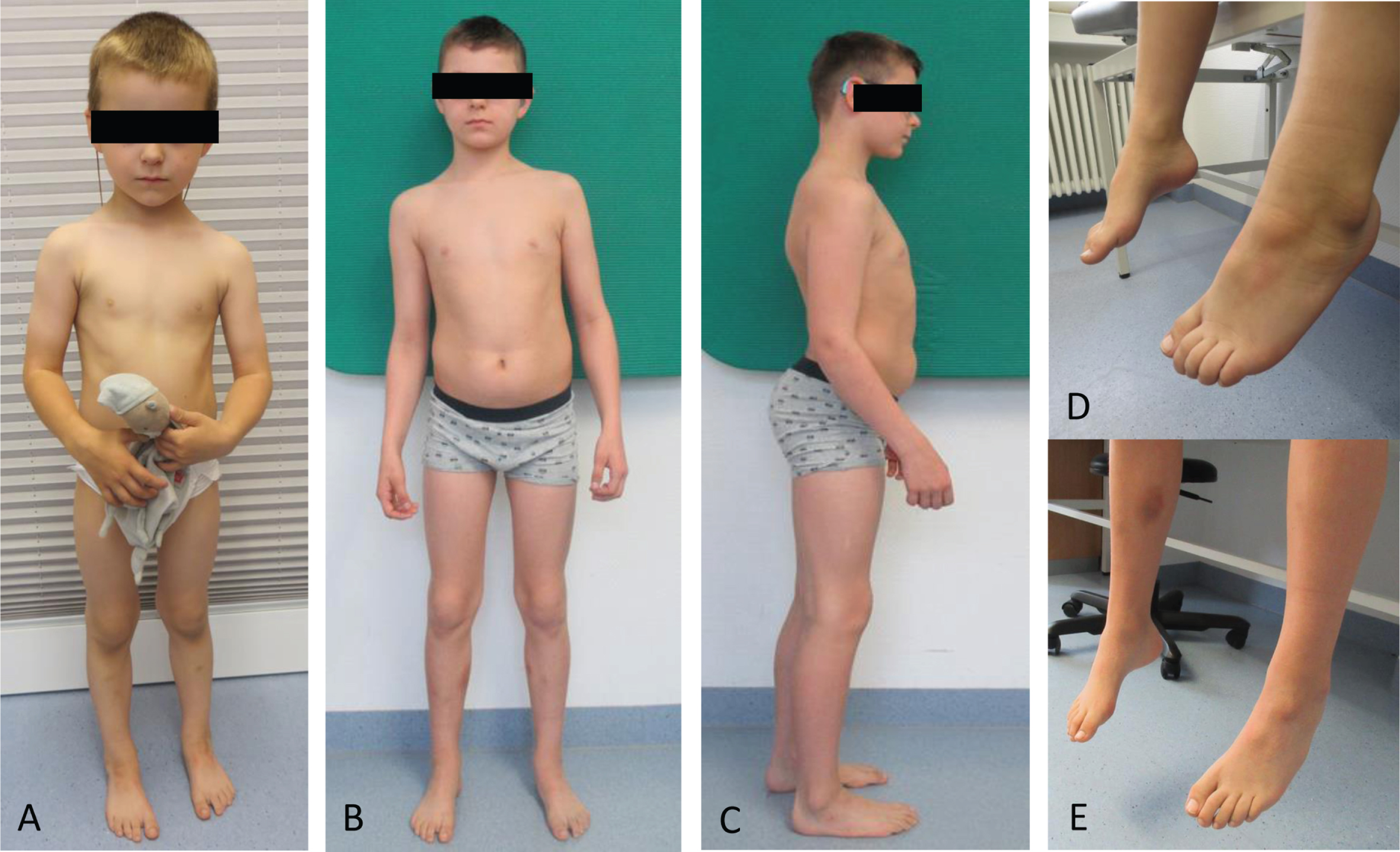 Clinical findings in one NEFL-patient. Patient 1 at the age of 3 years (A and D) and 11 years (B, C and E). Note lack of progress in pes cavus within the period of 7 years. Hyperlordosis at the age of 11 years (C).