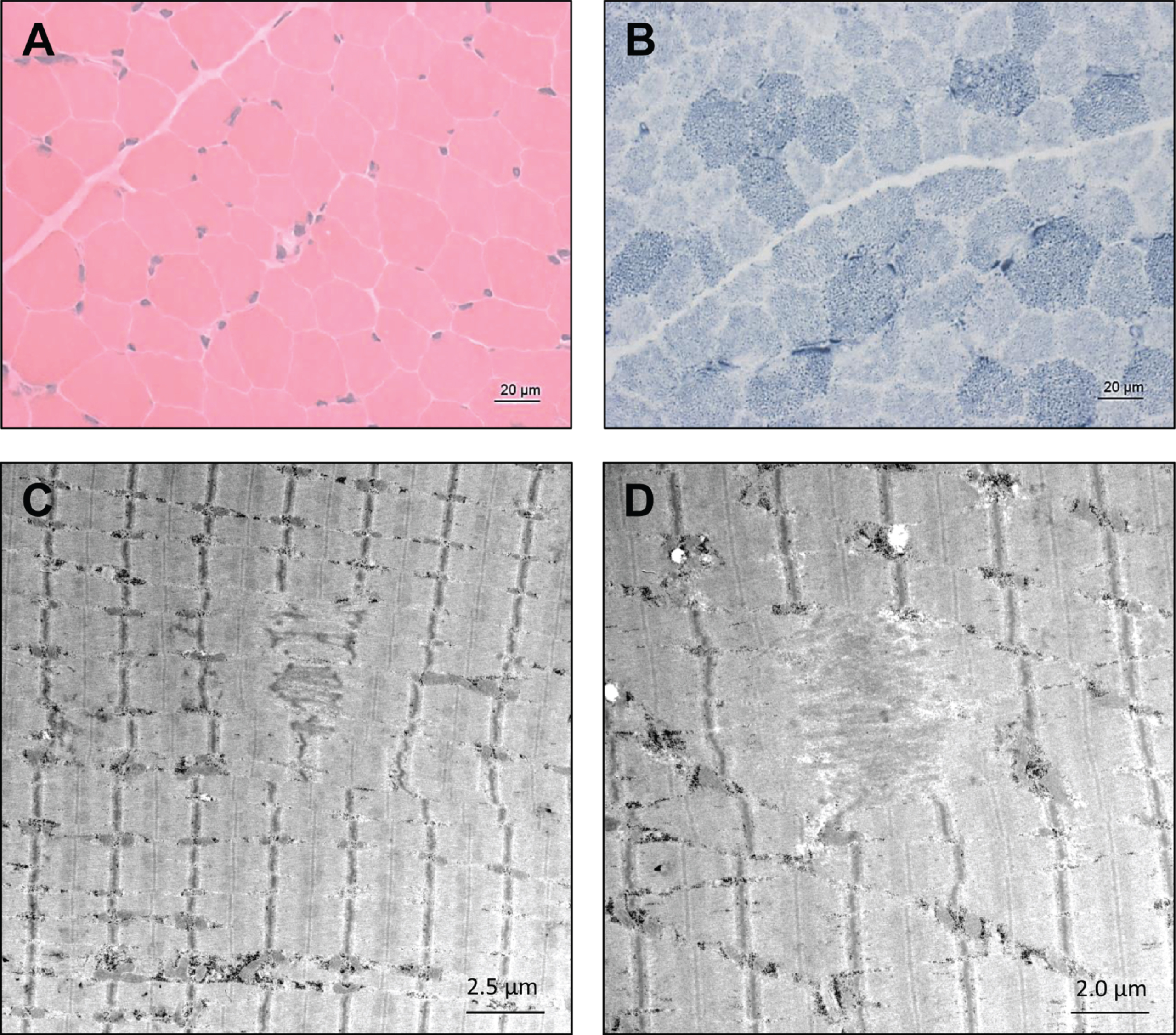 Microscopic findings in NEFL-mutant muscle. Haematoxylin & Eosin (H&E) staining did not reveal striking myopathic changes (A) whereas NADH-TR in some muscle fibers revealed increased subsarcolemmal reactivity indicative for mitochondrial accumulations in addition to pale regions in sum indicating altered mitochondrial distribution (B, arrows). Electron microscopic studies revealed focal alterations of sarcomere pattern with streaming of Z-discs and incidental pronounced Z-disc disruption as minicore-like lesions and small cytoplasmic bodies (C and D, arrowhead).