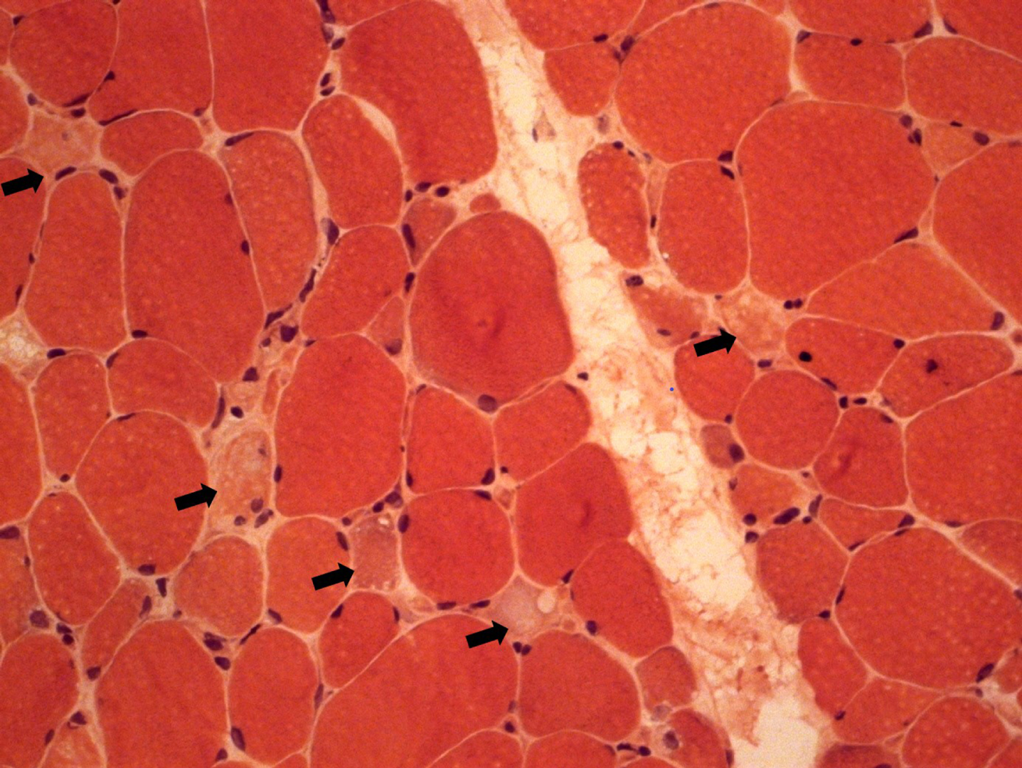 Muscle biopsy showing mild variation in fiber size and scattered necrotic fibers (black arrow).