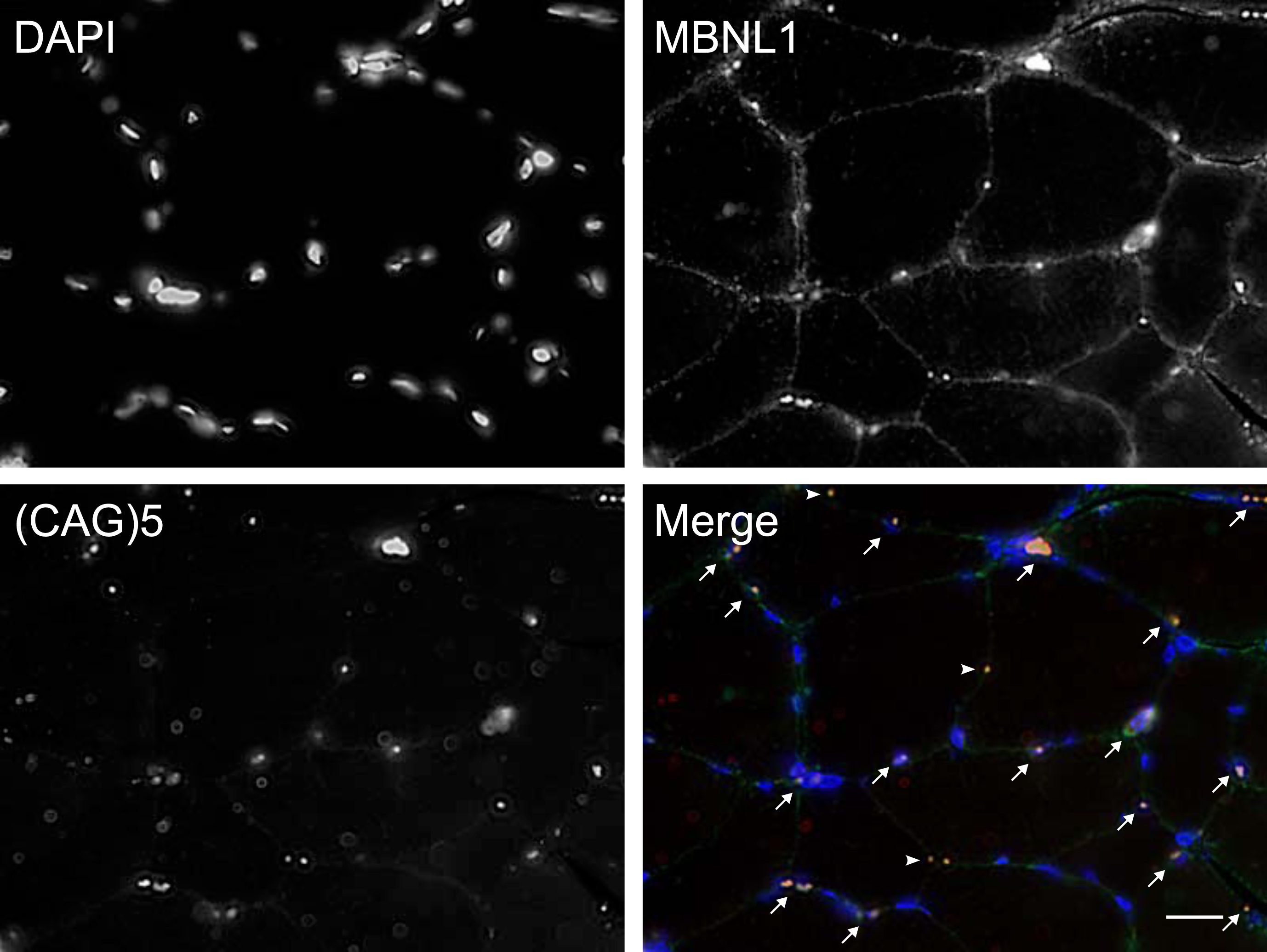 Representative image of colocalized nuclear foci FISH and MBNL-1 immunofluorescence. Scale bar = 20μm. DAPI showing myonuclei, MNBL1, (CAG)5 RNA FISH showing nuclear foci and Merge showing a composite image (DAPI in blue, MBNL1 in green and RNA foci in red). Arrows point to RNA foci/MBNL1 positive nuclei. Note that some RNA foci/MBNL1 aggregates did not colocalize with DAPI (arrowheads).