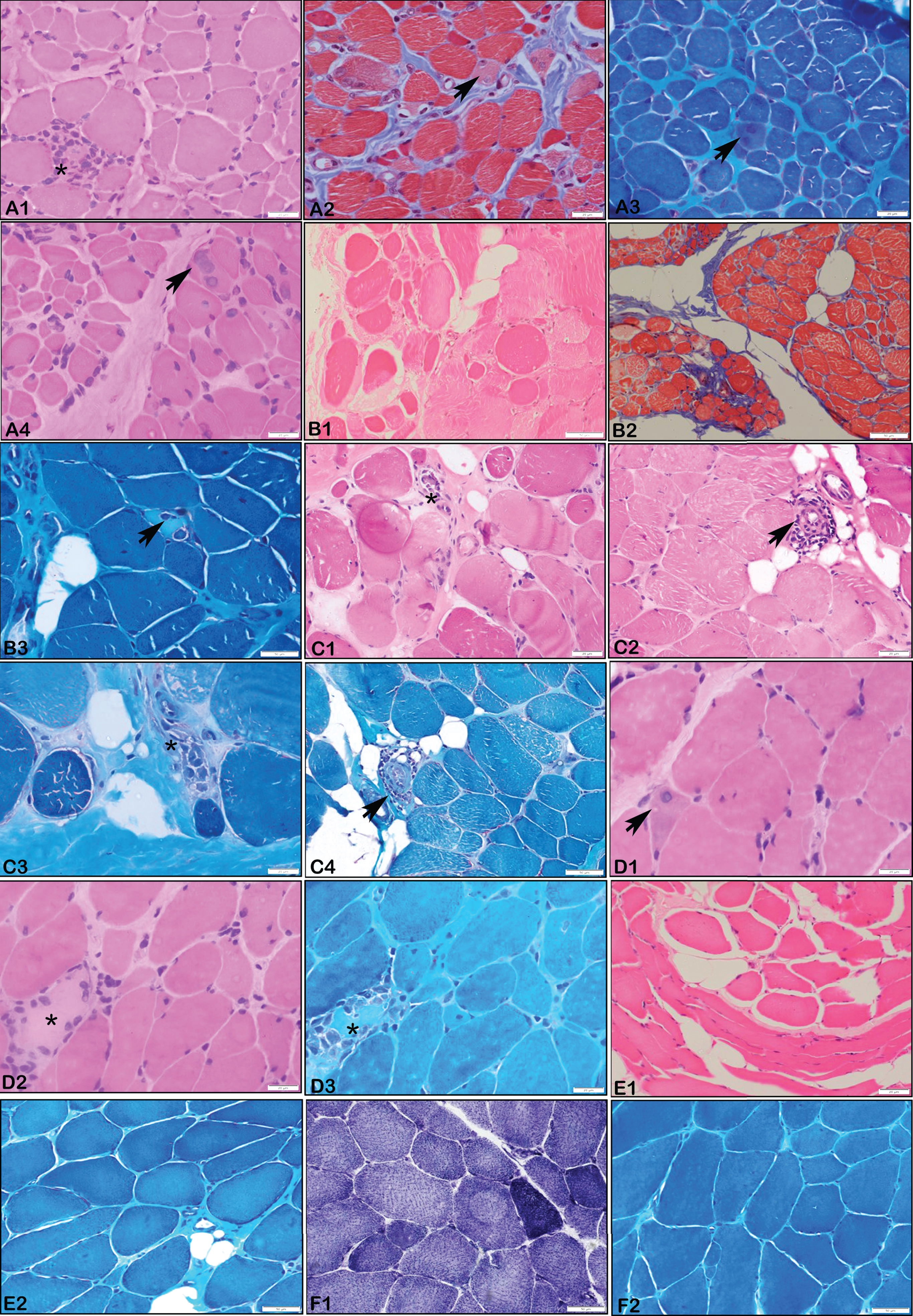 Muscle Biopsy Histopathology. A1 – A4 (P7 – LMNA, 4 years): Microphotograph showing muscle tissue with myopathic changes with scattered regenerating fibres (Arrows), endomyseal fibrosis and focal perivascular inflammation (asterix). (X 200 A1, A4 – H&E; A2 – Masson’s Trichrome stain, A3 – MGT stain). B1 – B3 (P8 – LMNA, 7 years): Microphotograph showing muscle tissue with myopathic changes with myophagocytosis (asterix), endomyseal fibrosis and perivascular inflammation (arrow). Note the myonecrosis in B 3 (asterix) (X 200 B1 – H&E;, B2 – Masson’s Trichrome stain; B3 – MGT stain). C1 – C4 (P9 – LMNA, 12 years): Microphotograph showing muscle tissue with myopathic changes with myophagocytosis (asterix), endomyseal fibrosis and perivascular inflammation (arrow). Variation in fibre size, nuclear clumps and adipocytic infiltration. (X 200 C1, C2 – H&E; C3, C4 – MGT stain). D1, D2, D3 (P3 – LMNA, 4 years): Microphotograph showing muscle tissue with myopathic changes with myonecrosis (asterix), endomyseal fibrosis and regenerating fibres (arrow). Variation in fibre size, nuclear clumps and adipocytic infiltration. (X 200 D1,D2 – H&E; D3 – MGT stain). E1, E2 (P6 – LMNA, 6 years): Microphotograph showing Muscle tissue with variation in fibre size, endomyseal fibrosis and adipocytic infiltration. (X200 E1, E2 – H&E; E2 – MGT stain). F1, F2 (P13 – EMD, 19 years): Microphotograph showing muscle tissue with neurogenic changes comprising of angulated atrophic fibres and type II fibre grouping (based on SDH stain, F1; X200, F2 – MGT stain).