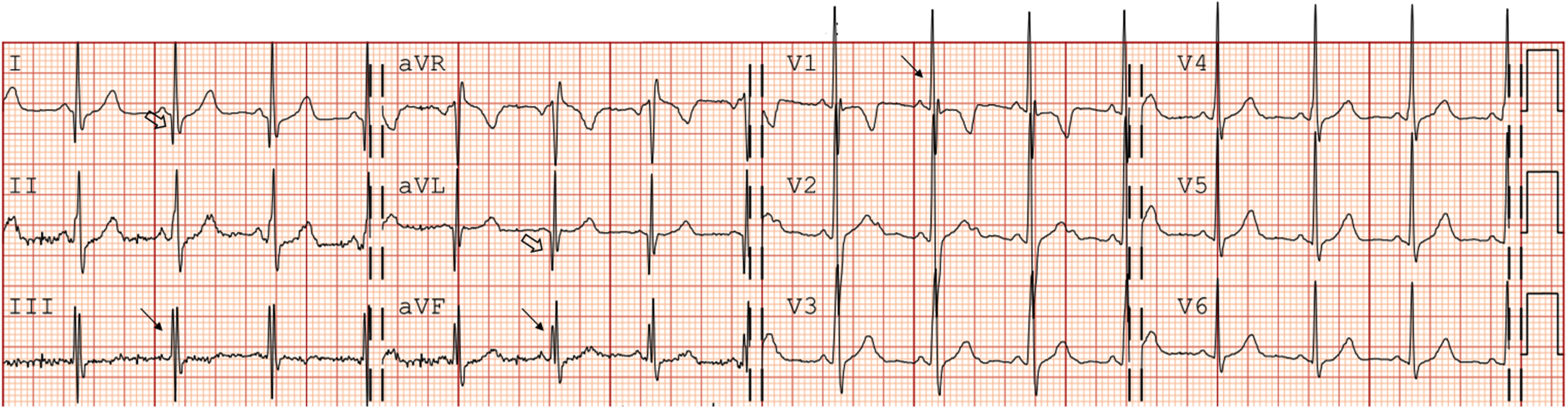 Electrocardiographic characteristics in a LAMA2-MD patient (patient 2, F, 8 years, baseline). QRS fragmentation in III, aVF and V1 (arrow); Q waves in I and aVL (open arrow); iRBBB (Rsr’ pattern in v1). iRBBB = incomplete right bundle branch block. LAMA2-MD = LAMA2-related muscular dystrophy.