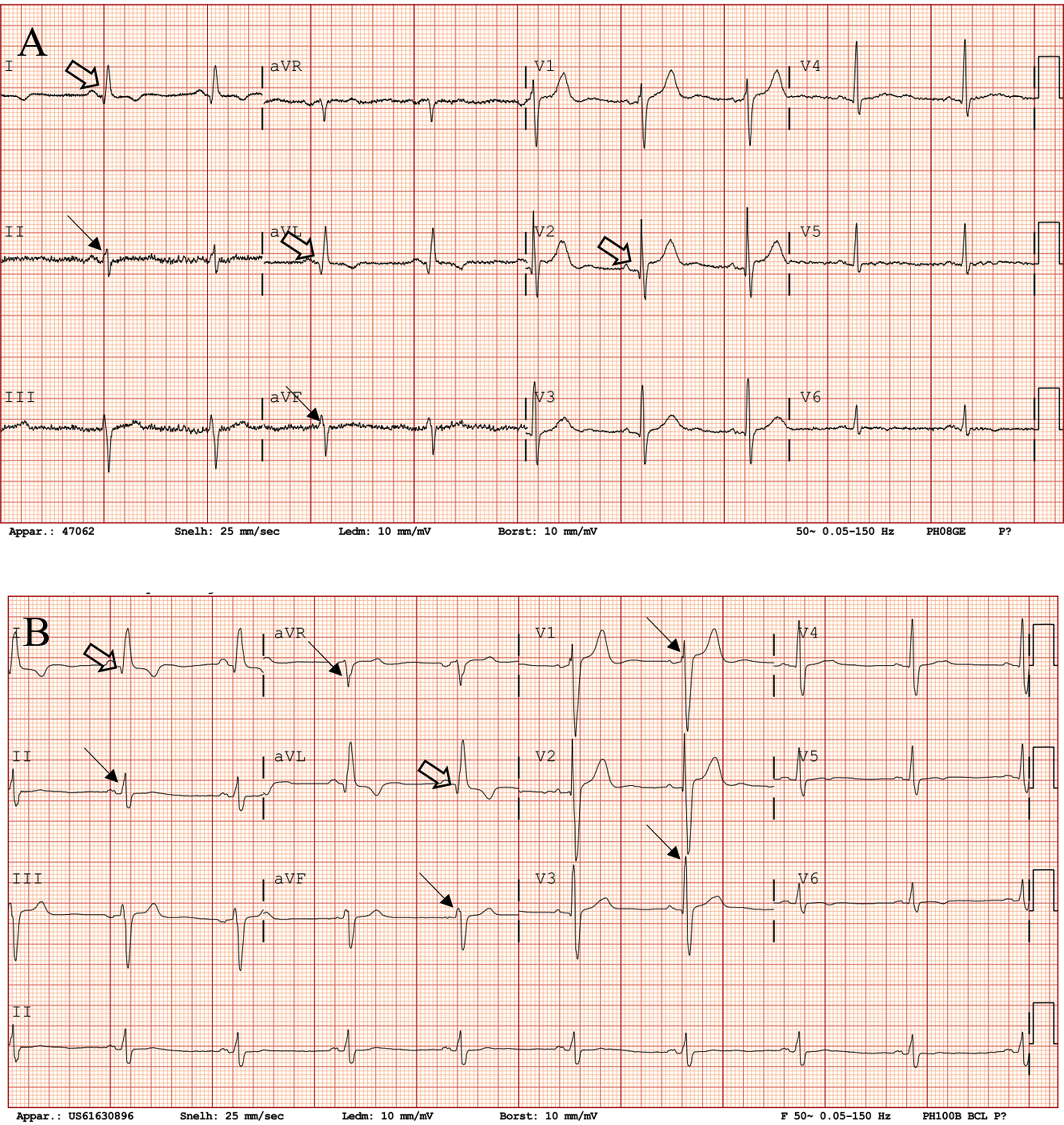 Electrocardiographic changes in a LAMA2-MD patient (patient 9, male) between baseline (42 years) and follow-up (43 years). These electrocardiographic changes are accompanied by 14% decrease in LVEF. (A) ECG at baseline, showing QRS fragmentation in leads II and aVF (arrow), Q waves in leads I, aVL and V2 (open arrow) and anterior fascicular block. Heart rate is 57 beats per minute (z-score –0.87), PR is 145 ms (z-score –0.23), QRS is 109 ms (z-score 0.49) and QTc is 420 ms (z-score –0.29). (B) ECG at one-year follow-up showing QRS fragmentation in leads II, aVR, aVF, V1 and V3 (arrow), Q waves in leads I and aVL (open arrow), poor R wave progression and anterior fascicular block. Heart rate is 55 beats per minute (z-score –0.97), PR is 145 ms (–0.23), QRS is 130 ms (z-score 1.77) and QTc is 410 ms (z-score –0.57). LAMA2-MD = LAMA2-related muscular dystrophy; LVEF = left ventricular ejection fraction; ECG = electrocardiography.