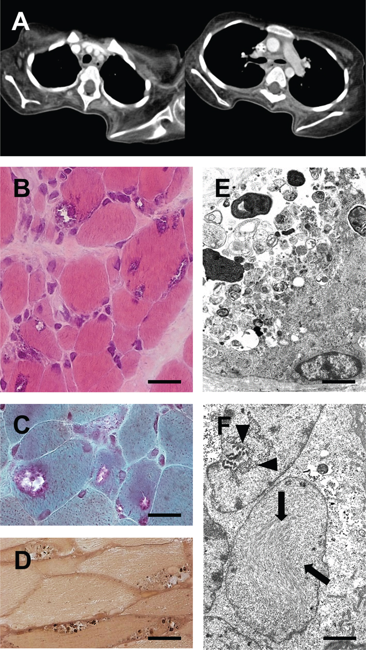 A patient with generalized early-onset myopathy. (A) Axial chest CT scans (performed at age 10 years for bacterial pneumonia) showing severe atrophy of shoulder girdle and back muscles. (B–D) Light microscopy of a muscle biopsy specimen revealing muscle fibre atrophy, endomysial fibrosis and presence of rimmed vacuoles. B: H&E; scale bar = 10μm. C: Gömöri trichrome; scale bar = 8μm. D: Semithin section, paraphenylendiamine; scale bar = 30μm. (E & F) Electron microscopy of a muscle biopsy specimen showing subsarcolemmal accumulation of pleomorphic granular and membranous material indicative of abnormal autophagy (in E) and thin (arrows) and thick (arrowheads) tubulofilaments in degenerating muscle fibre nuclei (in F). E: Scale bar = 3.0μm. F: Scale bar = 1.5μm.