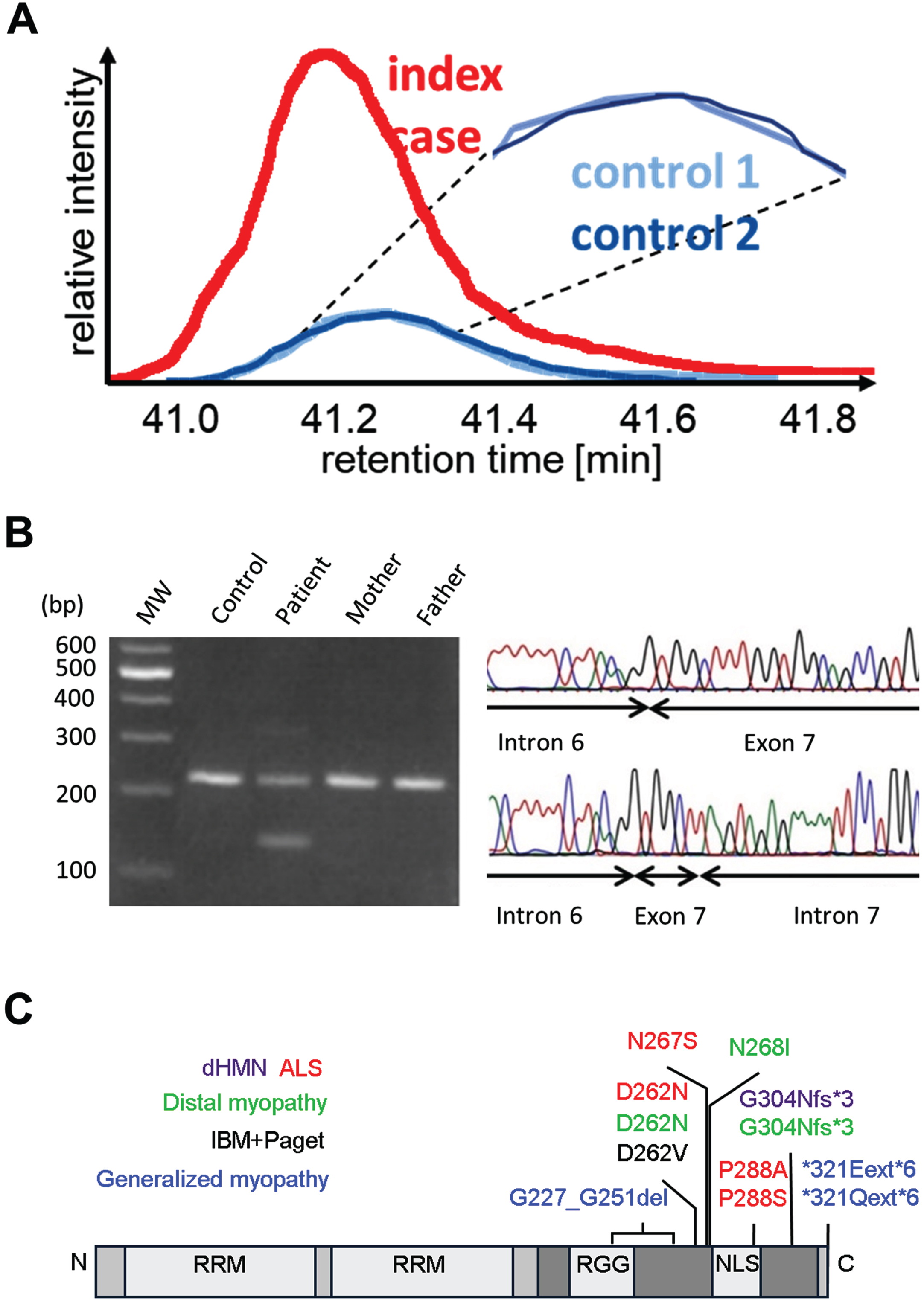 Identification of an HNRNPA1 deletion variant. (A) Proteomic profiling of patient-derived and control muscle tissue. Extracted ion chromatograms (XICs) of the unique HNRNPA1 peptide 285SSGPYGGGGQYFAKPR300 +++ at 543.5990 m/z indicated increased abundance in the patient sample. (B) Detection of the HNRNPA1 deletion variant in genomic DNA. Primers placed in introns 6 and 7 yielded a fragment of 221 bp in case of the wild-type sequence. An additional shorter 136 bp fragment was obtained when using patient’s DNA as a template. The sequencing chromatogram corresponding to the larger amplicon (top) shows the wild-type sequence for the intron 6 exon 7 junction. The chromatogram corresponding to the smaller amplicon (bottom) shows a partial deletion of exon 7 and intron 7. MW = molecular weight size standard. (C) Schematic overview of HNRNPA1 protein. HNRNPA1 contains two N-terminal RNA-recognition motifs (RRMs) and a C-terminal prion-like domain (PrLD), containing an arginine-glycine-glycine (RGG) motif and a nuclear localization signal (NLS). Known disease-causing variants are shown and color-coded for associated phenotypes. The deletion identified in our patient is highlighted in blue.