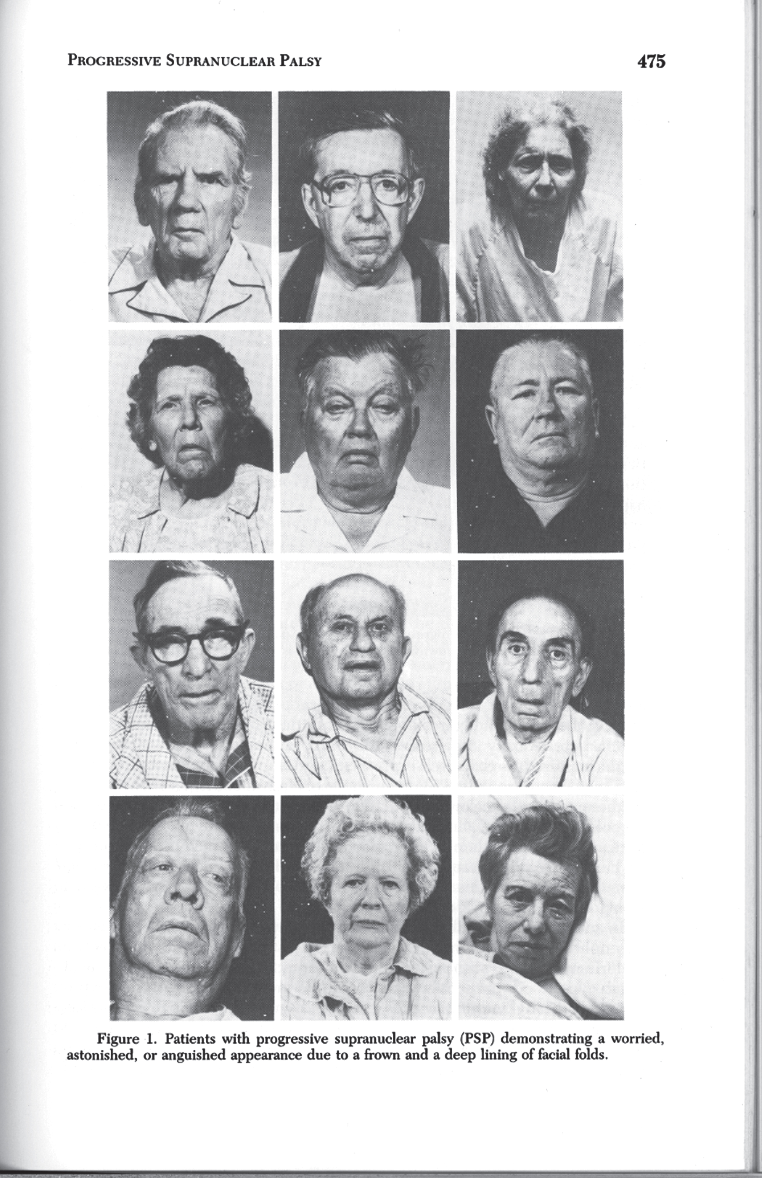 A montage of the distinctive facial appearance typically observed in patients with PSP, demonstrating a worried, anguished, or astonished appearance due to a frowning appearance and a deep lining of nasolabial folds. From Jankovic [1984] (page 475); reproduced with permission.