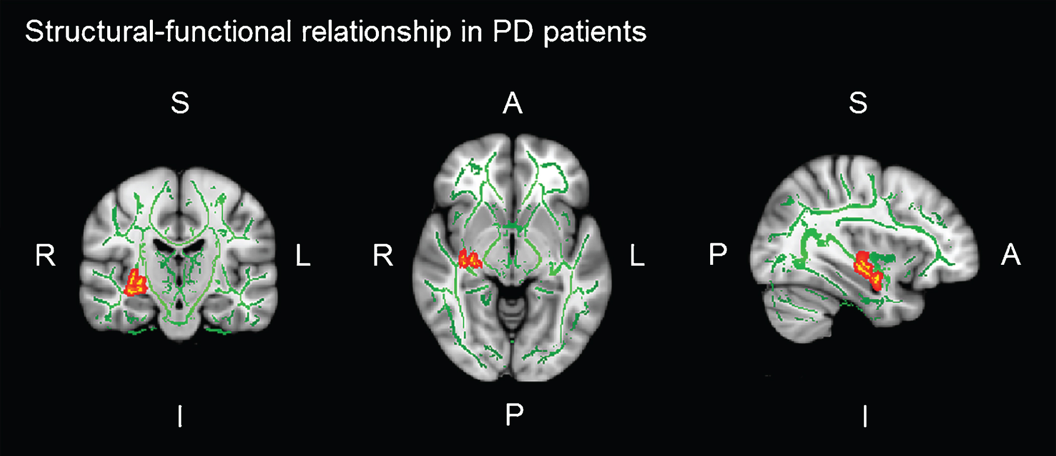 Significant voxel-wise correlations (red) between fractional anisotropy (FA) of the right uncinate fasciculus (UF) and brain activation in the left orbitofrontal cortex (IOFC) during verbal learning memory fMRI task. Montreal Neurological Institutes (MNI) template coordinates: x = 36 y = –5 z = 18.