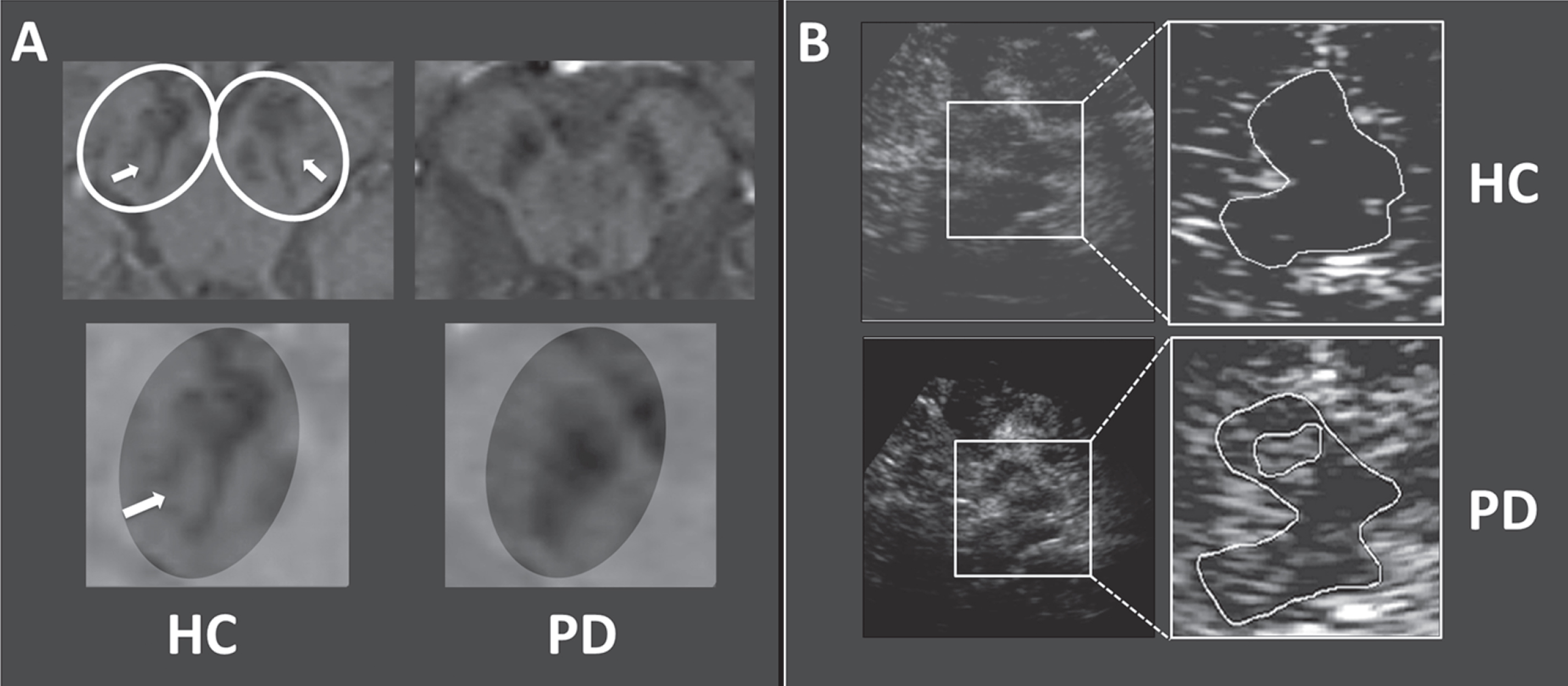 Midbrain / substantia nigra (SN) imaging with magnetic resonance imaging (MRI) and Transcranial sonography (TCS). A: Susceptibility weighted (SWI) MRI image of a healthy control (HC) at the left column, demonstrating the magnified dorsolateral nigral hyperintensity within the right SN. White arrows mark the dorsolateral nigral hyperintensity in the survey as well as in the magnified illustration. The right column show SWI images of a patient with Parkinson’s disease (PD), demonstrating the absence of the dorsolateral nigral hyperintensity. B: TCS images of mesencaphalic scanning planes showing typically butterfly-shaped mesencephalic brainstems from a HC with a normal midbrain echogenicity in the upper images. A PD patient with an enlarged midbrain echogenicity at the area of the SN (SN-hyperechogenicity) is shown in the lower images.