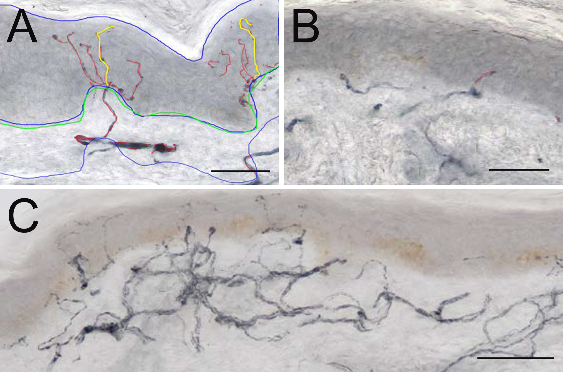 Representative examples of 50 μm sections from skin biopsies from more affected (M) and less affected (L) side from a PD patient, immunostained for GAP-43. Microphotograph from the more affected side (A) the blue tracings show area of epidermis and dermis; green line traces BM; red nerve fibres in epidermis and 50 μm subepidermal skin; yellow tracing shows nerve fibres measured for MAD. Note presence of branching nerves. Note closely positioned branching nerves. Panel B from less affected side shows area with short intraepidermal nerve fibres. Panel C shows a focal accumulation of nerves in subepidermal area which give rise to numerous NFs crossing the BM into epidermis. (Scale bars in A and B = 50 μm and in C = 100 μm).