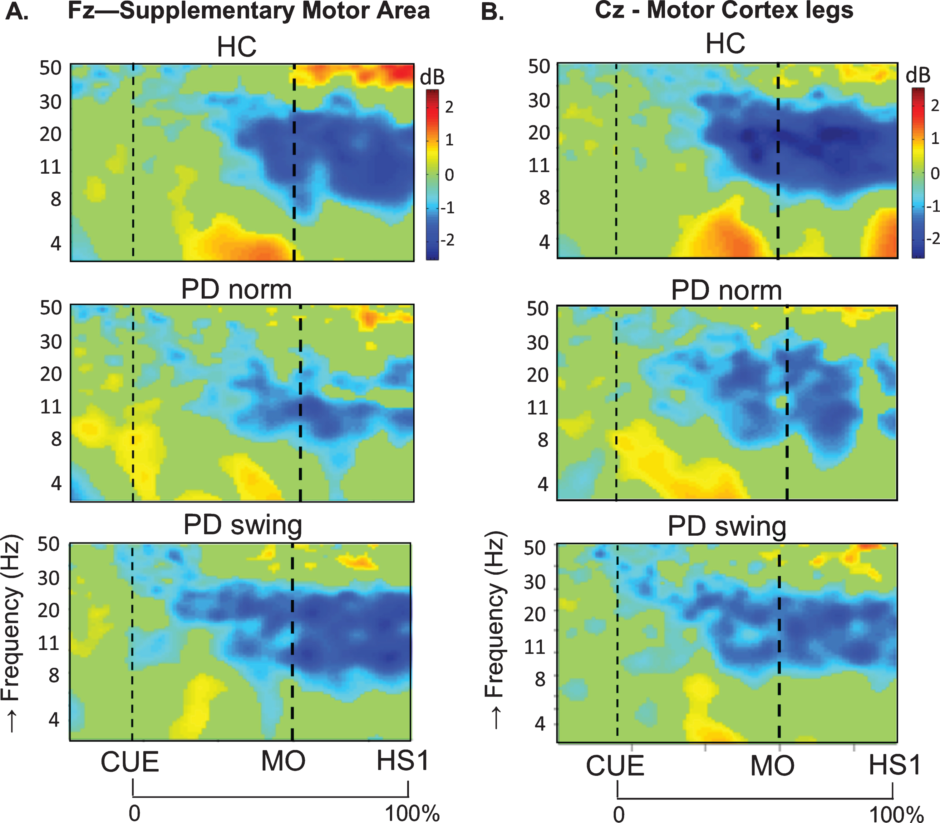 ERSP plots of gait initiation. Group averaged dynamic changes across the EEG frequency spectrum from electrodes over the putative supplementary motor area (A) and the motor cortex of both legs (B) during gait initiation in healthy controls (HC), Parkinson patients starting according to normal baseline instruction (PD norm) and Parkinson patients starting with enhanced arm swing (PD swing). Event related desynchronization (ERD) is illustrated in blue and event related synchronization (ERS) in red. Vertical lines mark the occurrence of the beep (CUE), movement onset (MO) and first heel strike (HS1). Non-significant changes (p > 0.05) are set to 0 dB (green). ERSP, event related spectral perturbations; dB, decibel