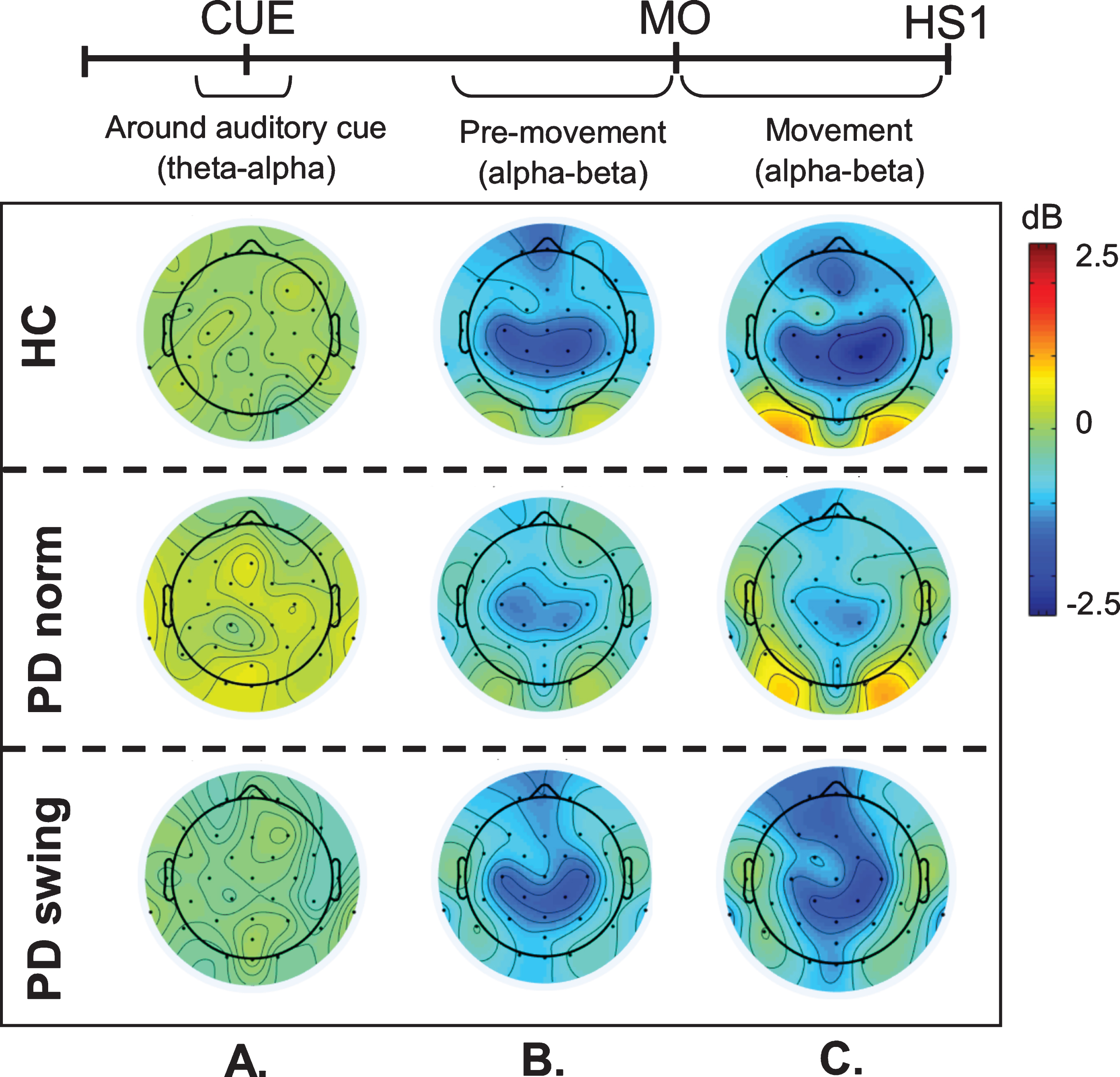 ERSP scalp distribution maps during gait initiation. Group averaged topographic distribution of the event related spectral perturbations (ERPS) over the entire scalp (32 channels) during gait initiation in healthy controls (HC, upper row), normal baseline starting in Parkinson patients (PD norm, middle row) and Parkinson patients starting with enhanced arm swing (PD swing, lower row). Regarding the multiple stages of gait initiation, the three most prominent time-intervals, characterized by distinct frequency bands recorded at Fz and Cz electrode were selected, i.e., the interval between 100  ms prior and 100  ms after the auditory cue (CUE), the 500  ms interval preceding movement onset (MO) and the interval between MO and first heel strike (HS1). Event related desynchronization (ERD) is illustrated in blue, event related synchronization (ERS) in red. dB, decibel