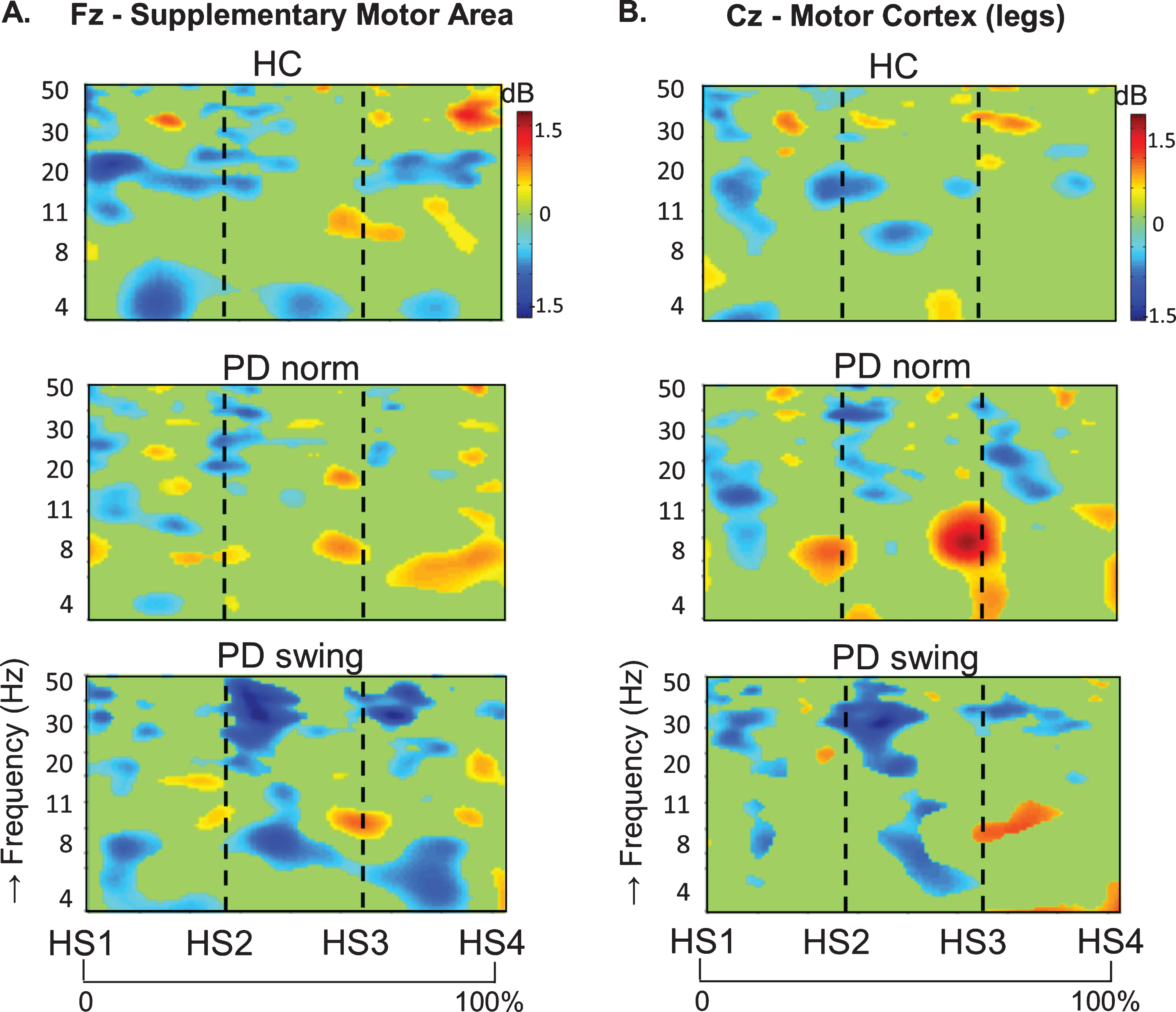 ERSP plots during step two, three and four. Dynamic changes across the EEG frequency spectrum from electrodes over the putative supplementary motor area and the motor cortex of the legs during the transition steps two, three and four towards regular gait, in healthy controls (HC, upper row), Parkinson patients starting according normal baseline instruction (PD norm, middle row) and Parkinson patients starting with enhanced arm swing (PD swing, lower row). Event related desynchronization (ERD) is illustrated in blue and event related synchronization (ERS) in red. ERSP, event related spectral perturbations; HS1, first heel strike; HS2, second heel strike; HS3, third heel strike; HS4, fourth heel strike; dB, decibel.