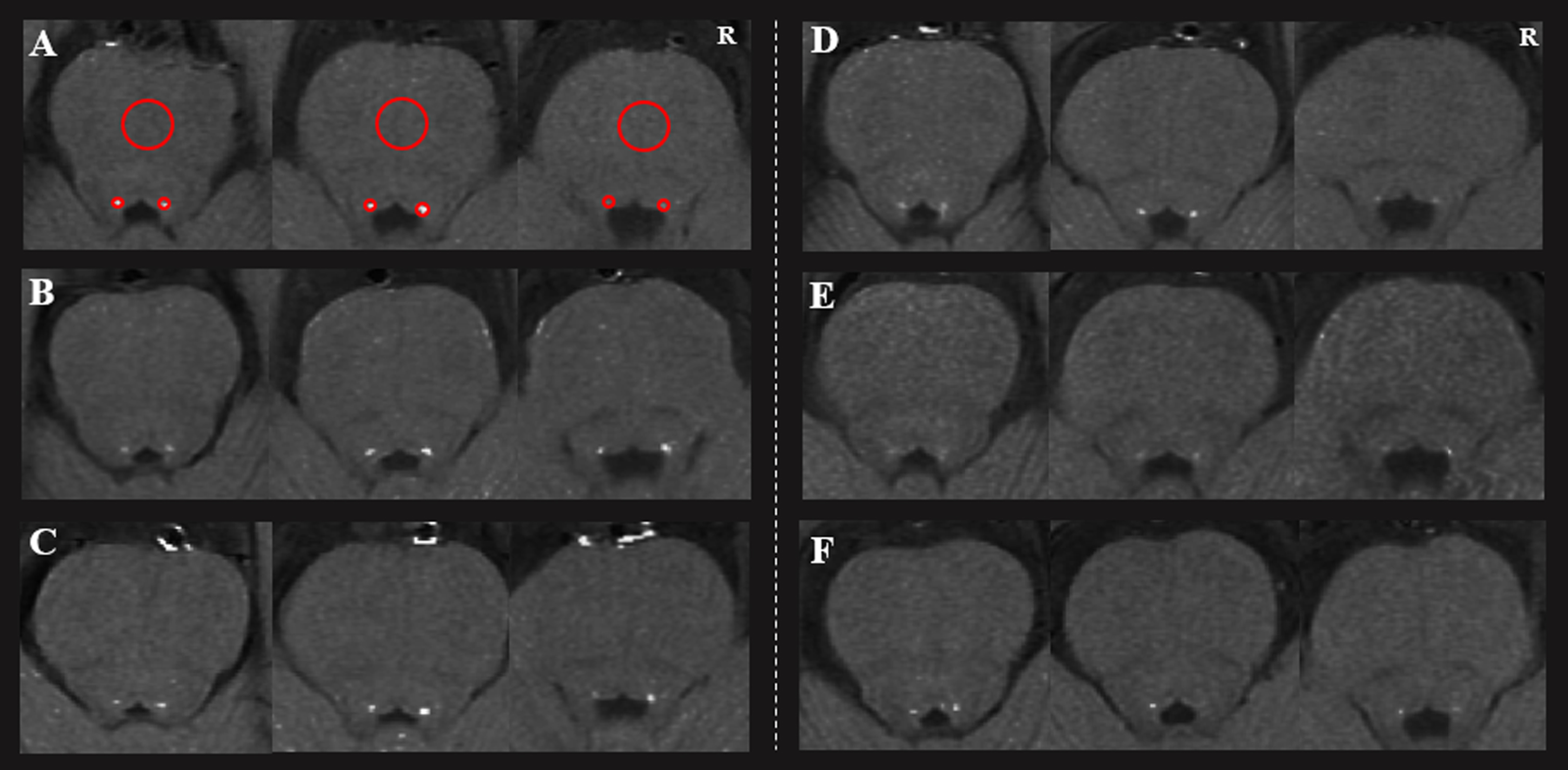 The loci coeruleus of three healthy controls (A, B, C) and three Parkinson’s disease patients (D, E, and F). Two regions of interest (red circles) were placed at the LC, with a larger one at the pons. R, right.