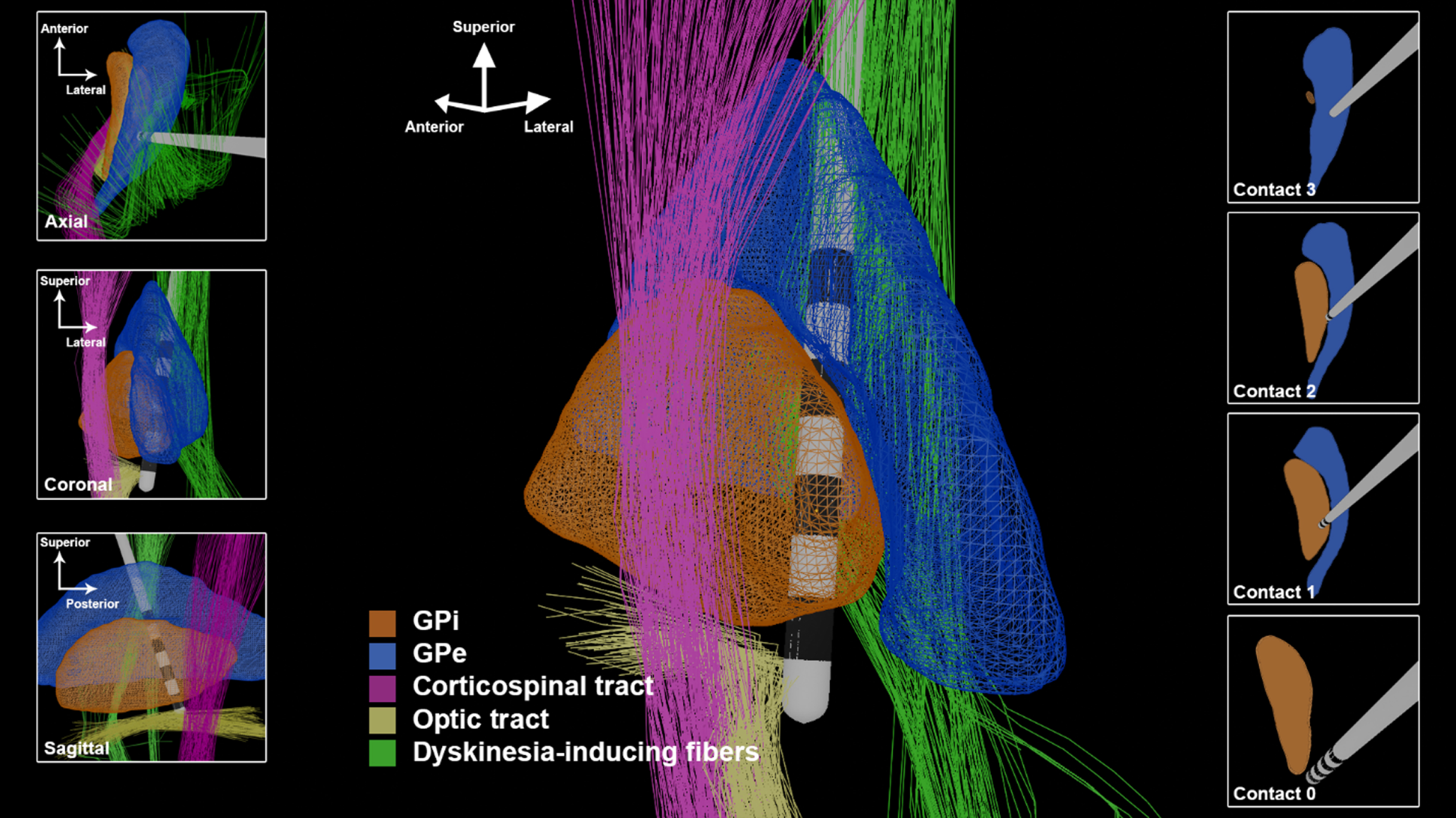 The 3-D GPi DBS image utilizing trajectories and spatial boundaries for targeting and programming. The lead depicted in this figure has 1.5 mm spacing between contacts and a contact height of 1.5 mm.