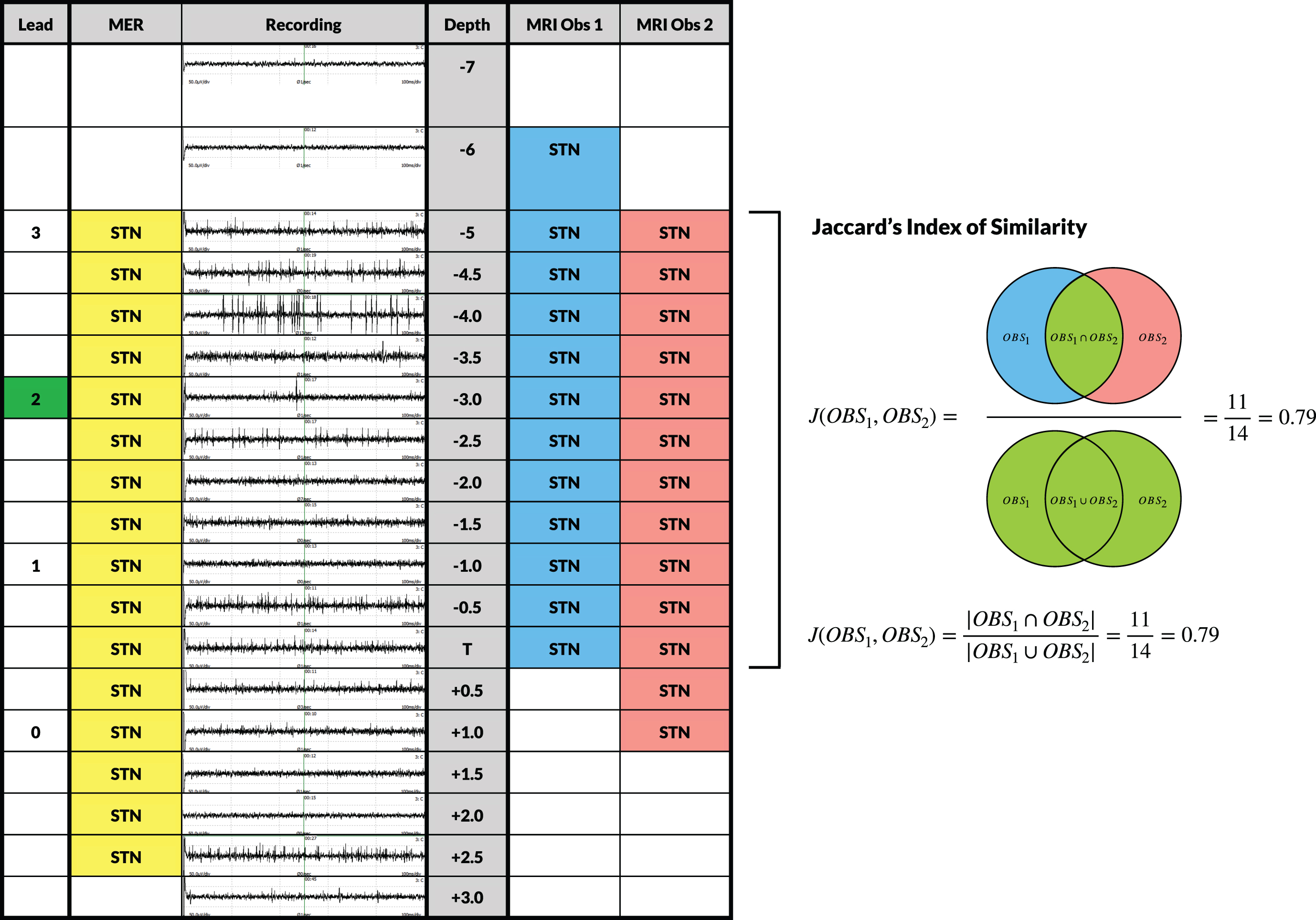 Evaluation of MER signals and inter-observer variability of the MRI-defined STN along the planned trajectory. Visualization of a one-sided standard evaluation in a particular patient. Depth of the recordings ranges from 7 mm above target (T) to 3 mm below in steps of 0.5 mm starting from 5 mm above target. MER signals of the central track were visualized at each depth and were interpreted by a dedicated neurophysiologist. Characterization of the signals as being STN-specific was indicated in the ‘MER’ column. Two independent observers assessed whether the planned trajectory was located within the MRI-defined STN at every depth. Subsequently, a Jaccard’s Index of Similarity was calculated for MRI Observer 1 and Observer 2. The Jaccard’s Index of Similarity was defined as the number in both sets divided by the number in either set (intersection over union; see formula). The ‘Lead’ column indicates the depth of the contacts of the final lead with the active contact at 12 months follow-up marked in green.