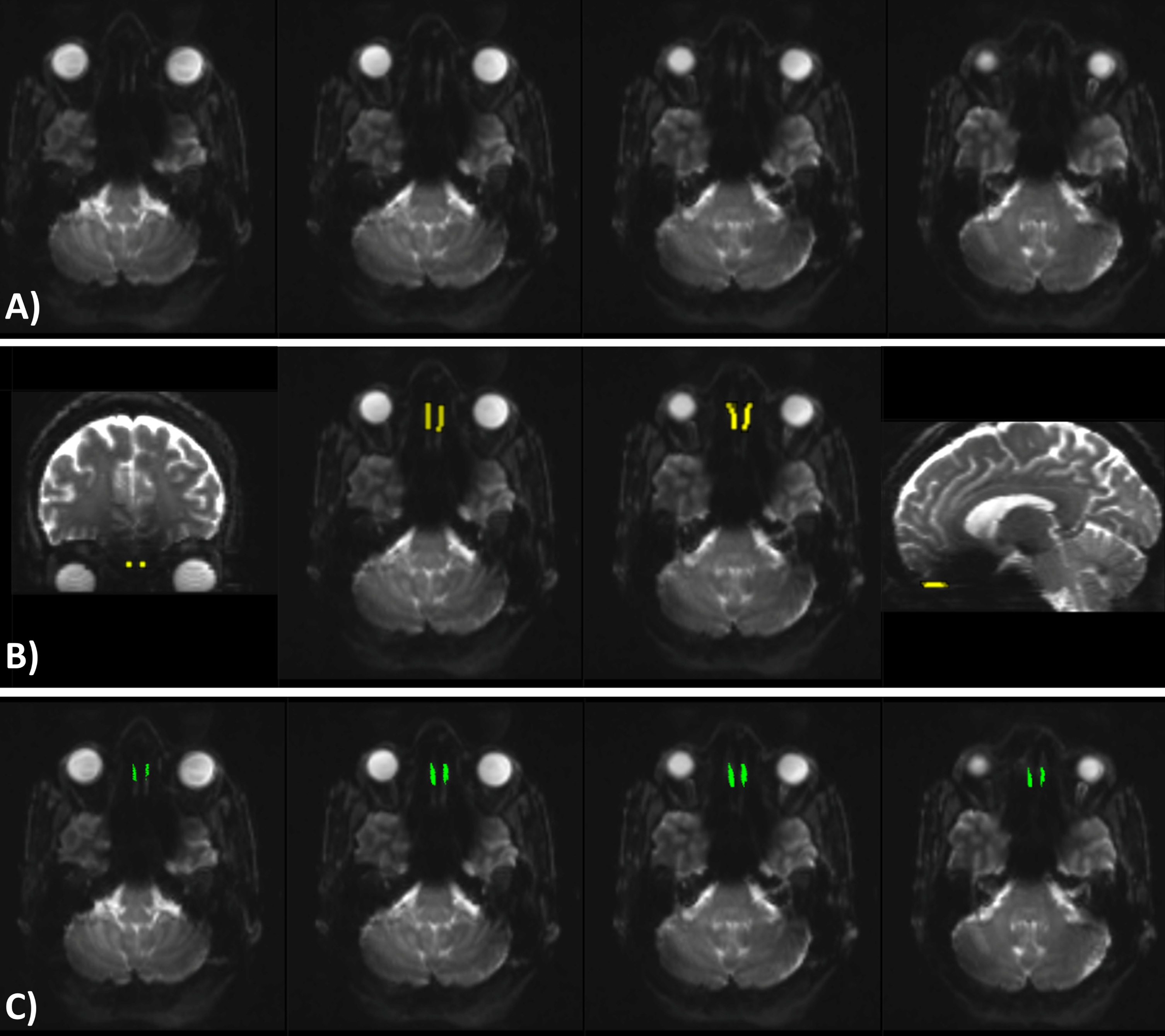 A) Four axial slices of the average corrected B0 volumes. The two middle images were selected as the ones having the best visible olfactory tract. B) Coronal, axial, and sagittal view of the seed ROI representing the olfactory tract area. C) The same four axial slices as shown in A, showing the olfactory tract tractography results. Images are in radiological orientation.