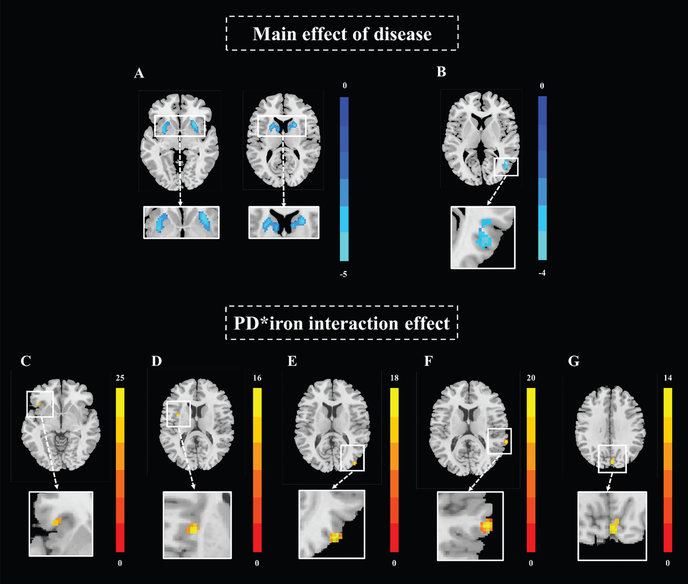 Main effect of disease, and interaction effect between nigral iron and disease on BGN and VN. (A) Main effect of disease on BGN; (B) main effect of disease on VN; (C) interaction effect cluster1 in BGN; (D) interaction effect cluster2 in BGN; (E) interaction effect cluster1 in lVN; (F) interaction effect cluster2 in lVN; (G) interaction effect cluster in mVN. All results are displayed at GRF correction (voxel level p < 0.005, cluster level p < 0.05). Color bars are proportional to T/F values. BGN, basal ganglia network; VN, visual network; lVN, lateral visual network; mVN, medial visual network; GRF, Gaussian Random Field.