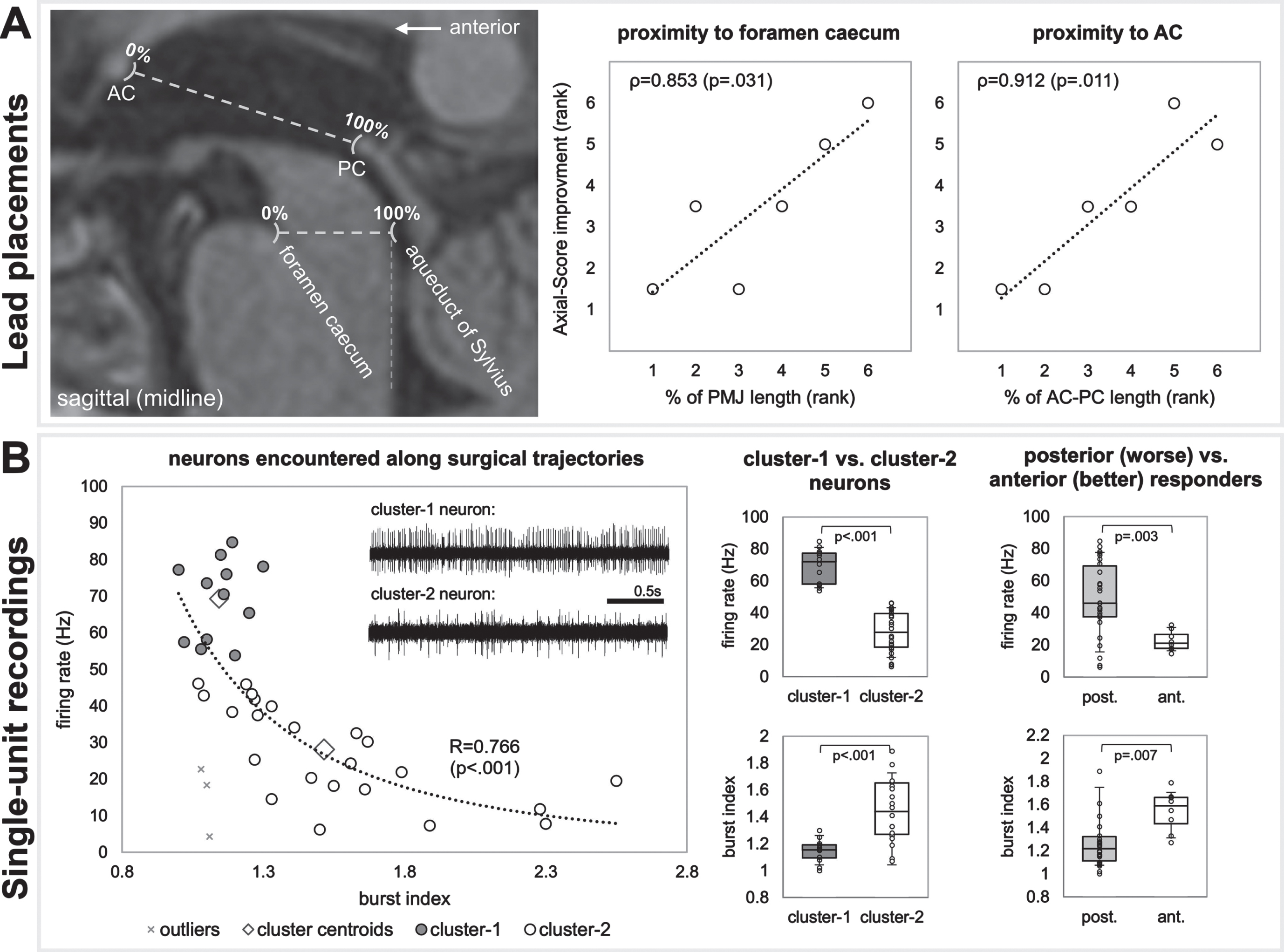 A) Lead placement correlates, and B) single-unit recordings. A) MRI results suggest that more anterior lead placements were favorable. B) Single-unit recordings show two clusters of neurons (cluster-1 being faster and more regular versus cluster-2 being slower and less regular). Neurons resembling cluster-2 were more prominent in recording trajectories of patients with more anterior electrode placements (who had better therapeutic responses).