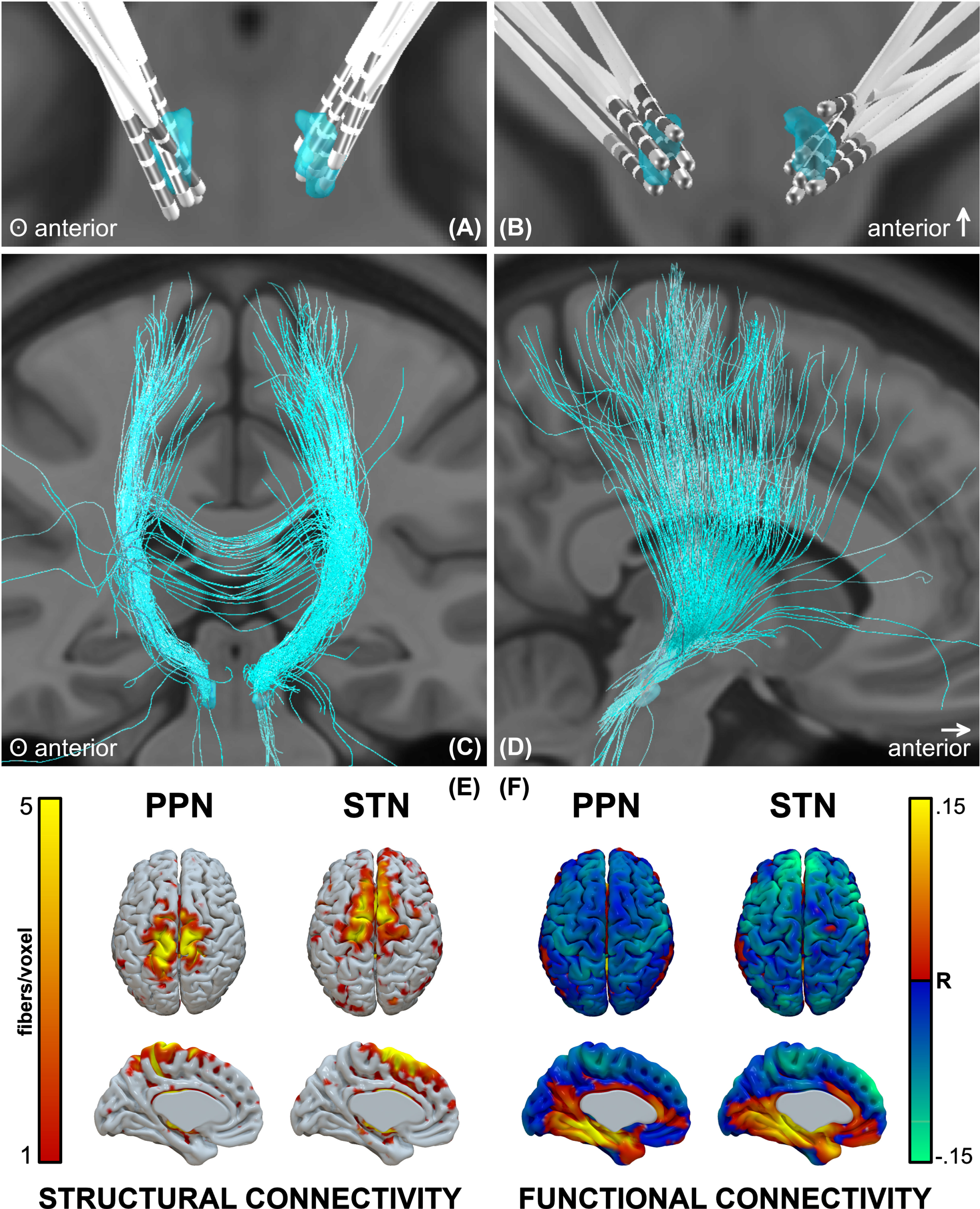 Lead locations and groupwise structural and functional connectomic profiles. A, B) Reconstructions of all electrodes, C, D) fibers traversing the groupwise VTA, and E) structural and F) functional connectivity profiles.