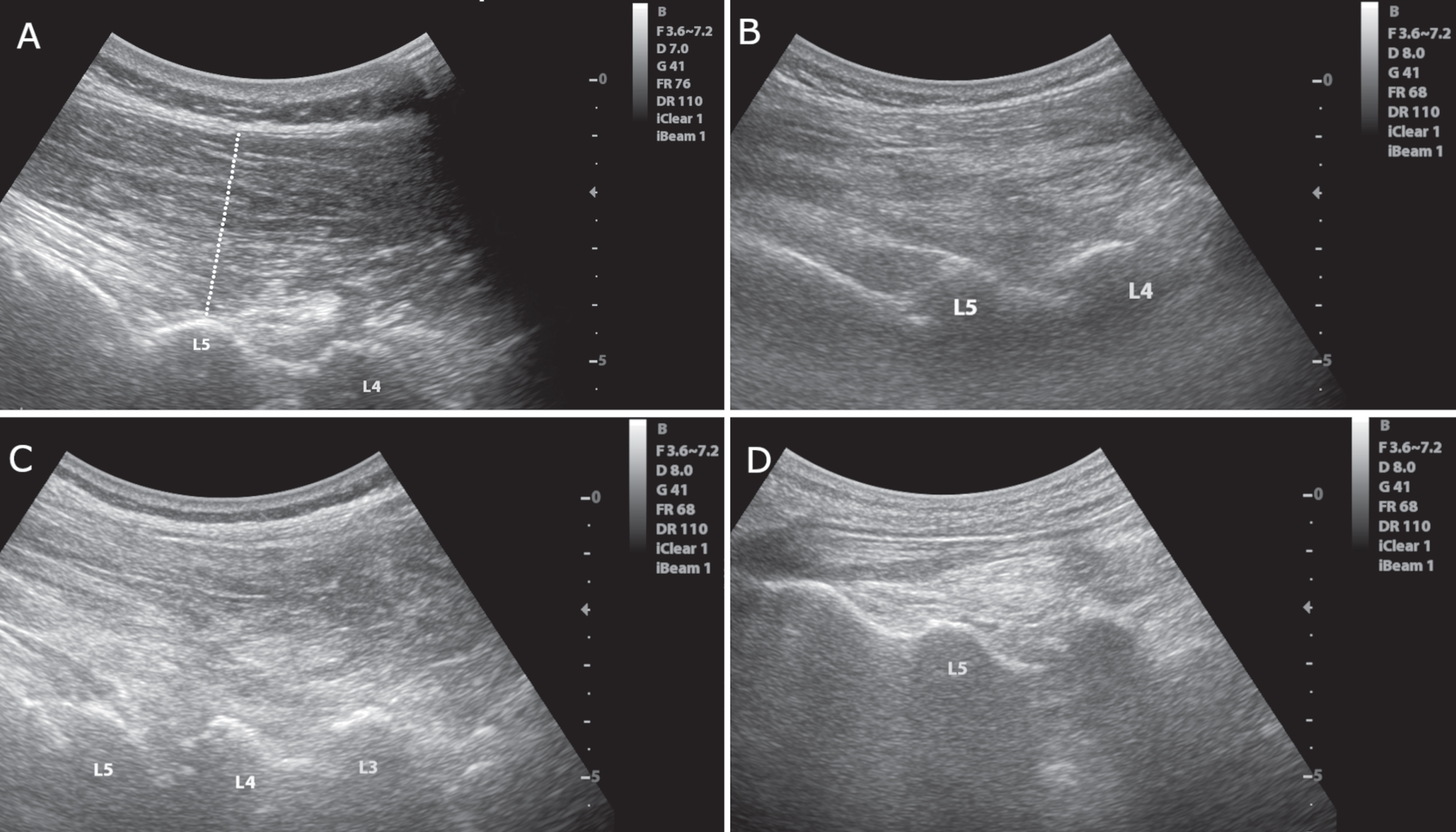 Longitudinal images of the paravertebral musculature at the interlaminar plane. A) Image of a 62-year-old male participant with no Parkinson’s disease or camptocormia. The thickness of the muscle was assessed by drawing a perpendicular line between the end of the subcutaneous tissue and the lamina of the lumbar vertebra for each vertebral level as shown. B) Image of a 68-year-old female participant with Parkinson’s disease but no camptocormia. C) Image of an 80-year-old male participant with Parkinson’s disease and acute camptocormia with a 45° flexed posture. D) Image of a 70-year-old female participant with Parkinson’s disease and chronic camptocormia with an 80° flexed posture. Note the reduced muscle thickness in the patient with chronic camptocormia (D). Also, increased echogenicity can be seen in patients with acute and chronic camptocormia indicating muscle pathology (C and D).