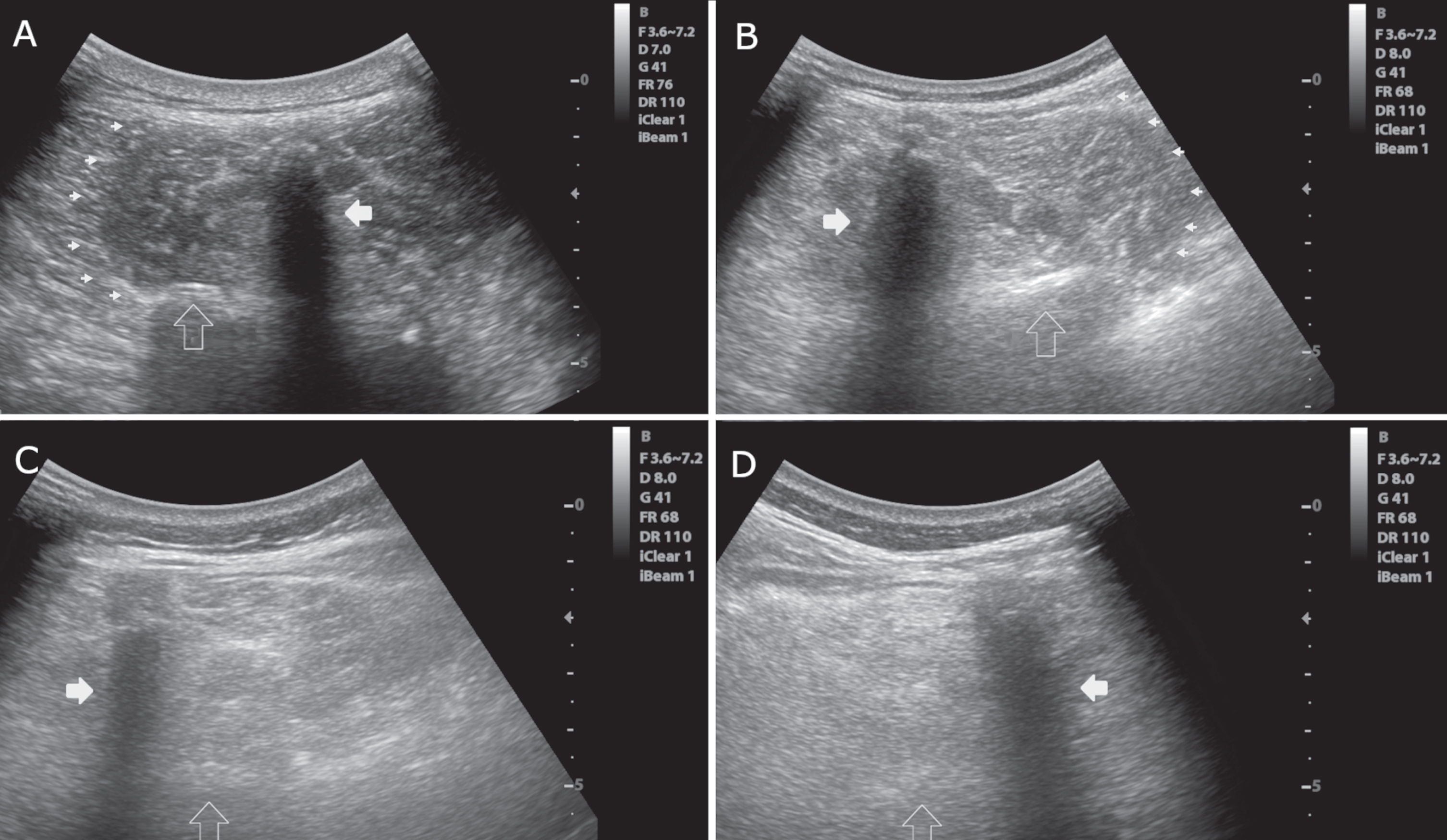 Axial images of the multifidus muscle at the level of L3. A) Normal muscle echogenicity with a “starry night” pattern, clearly visible muscle borders (small arrowheads), a normal bone reflection (empty vertical arrow) and spinal process (white horizontal arrow). Heckmatt score = 1. B) Slightly increased muscle echogenicity. The borders of the muscle (arrowheads) and bone reflection (empty vertical arrow) are still seen. Heckmatt score = 2. C) Markedly increased muscle echogenicity with no clear muscle borders. Bone reflection (empty vertical arrow) is hardly detectable. Heckmatt score = 3. D) Markedly muscle increased echogenicity with no discernible echotexture showing a “rubbed out” pattern. Bone reflection (empty vertical arrow) is lost. Heckmatt score = 4. White horizontal arrow, spinous process; small arrowheads, lateral border of the multifidus; empty vertical arrow, lamina vertebrae.