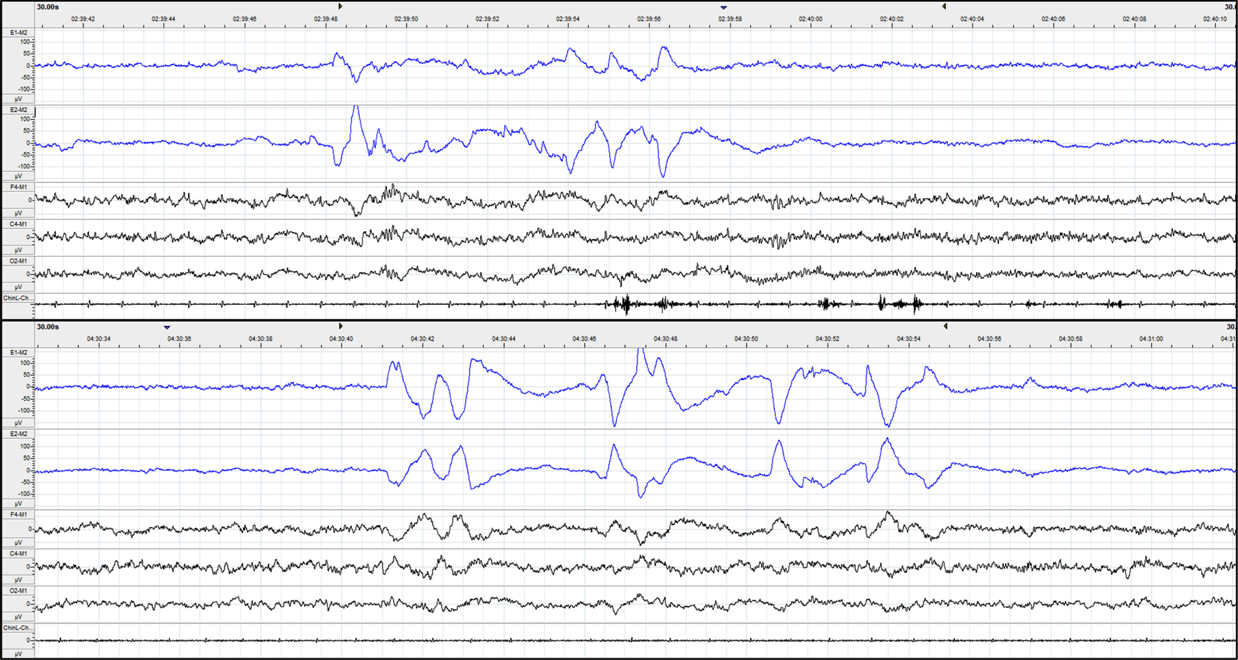 Raw data of 30-second epoch of REM sleep for PD (upper) and controls (lower). The first two channels marked in blue are left and right EOG, followed by frontal (F4), central (C4), and occipital (O2) EEG channels. The last channel is the chin EMG measured from the mentalis muscle. Note the much higher REM density of controls, compared to PD. Across the whole night, controls had a REM density of 7.5, compared to a REM density of 4.3 in a PD patient.
