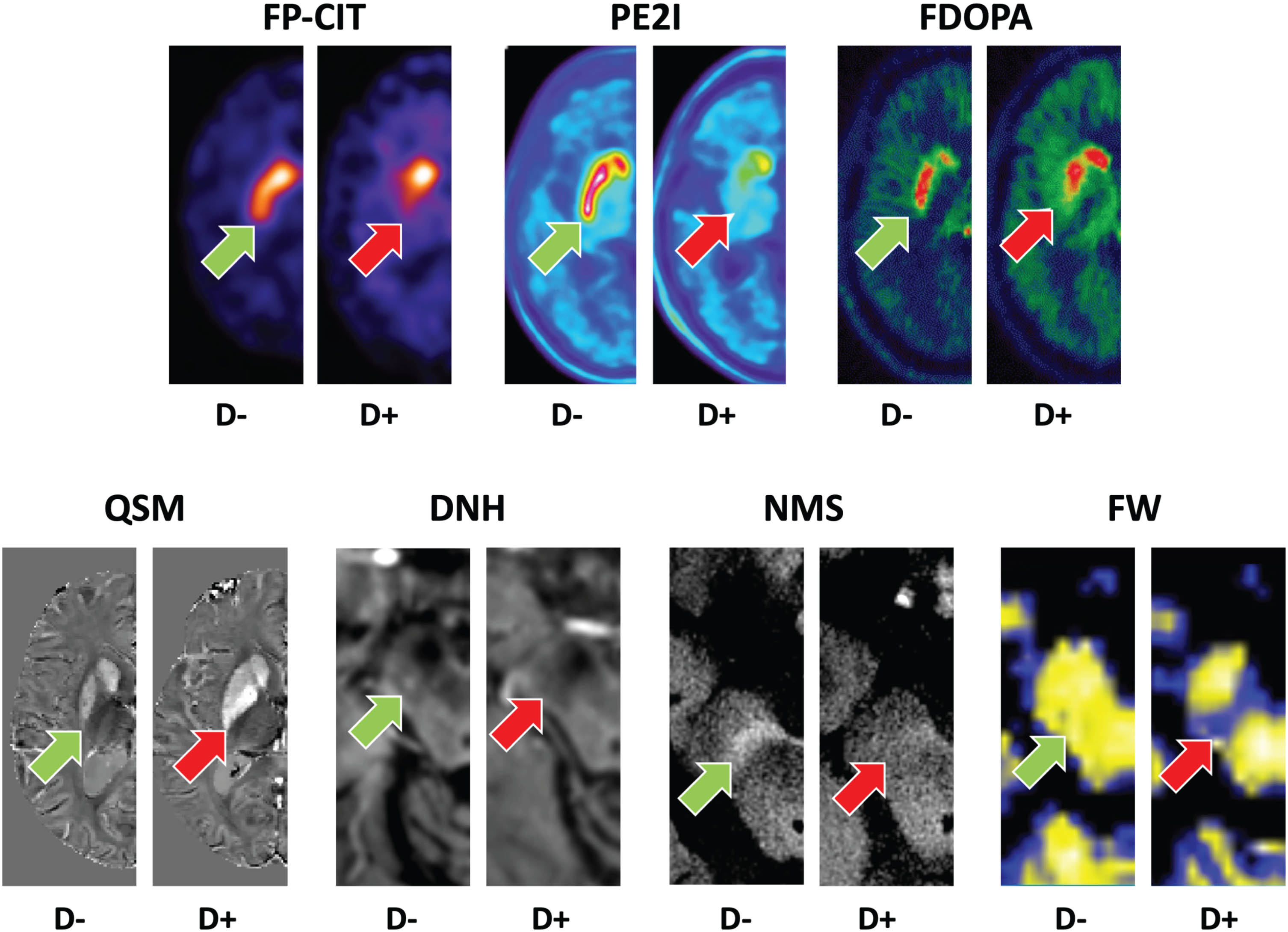 Imaging Biomarkers of Dopaminergic Degeneration in PD. Various PET or MRI modalities can capture dopaminergic degeneration (see Table 1 for availability and use in clinical routine). Examples of normal (D–) and pathological (D+) findings. Red arrows indicate abnormality. Normal findings pointed out with green arrow. All images are in axial orientation. FP-CIT: dopamine transporter SPECT using [123I]FP-CIT; PE2I: dopamine transporter PET using [18F]FE-PE2I; FDOPA: presynaptic dopamine turnover PET using [18F]DOPA; QSM: Quantitative susceptibility mapping MRI of iron load the striatum. DNH: Dorsal nigral hyperintensity in SWI or T2* MRI, a.k.a. ‘swallow tail sign’. NMS: Neuromelanin-sensitive MRI of the substantia nigra; Courtesy Stephane Lehericy, Rahul Gaurav (Paris Brain Institute, France). FW: Free water diffusion MRI of the posterior substantia nigra; Courtesy David Vaillancourt (University of Florida, USA).