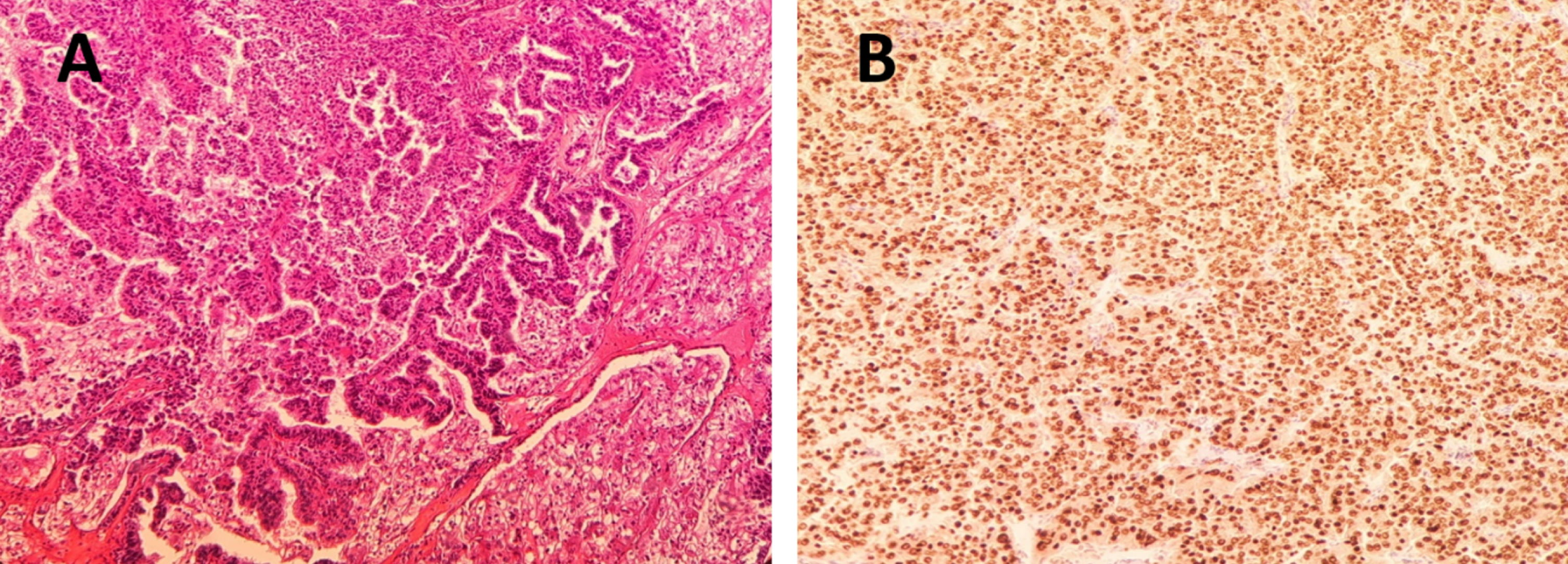 A. Hematoxylin-eosin staining 40x. Neoplastic proliferation of cells with clear eosinophilic cytoplasm distributed in a papillary pattern. B. TFE3 staining, 40X. With TFE3 immunohistochemistry technique, the clear eosinophilic cytoplasmic cells of the papillary component show intense and diffuse positive nuclear immunoreactivity.