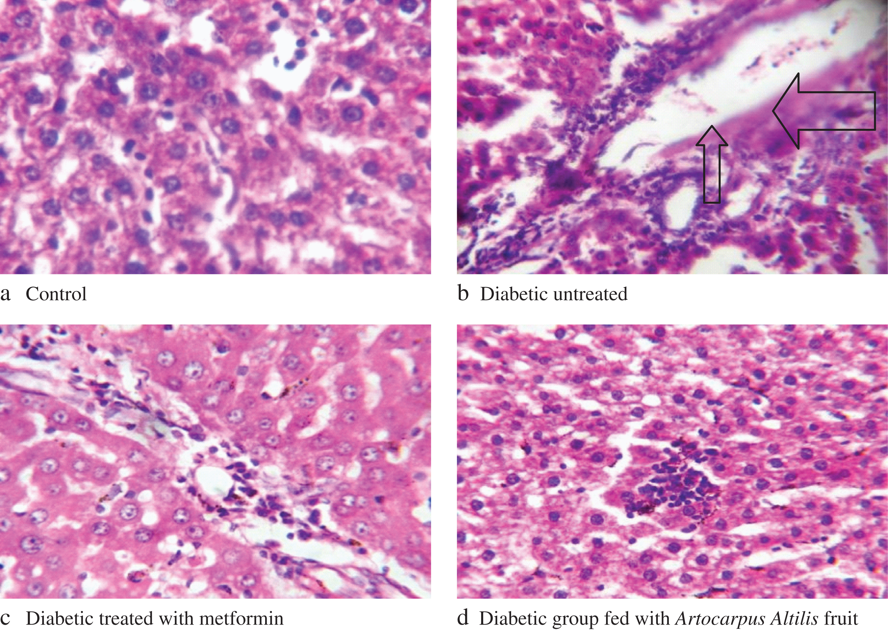 Changes in histology of Alloxan-Induced Diabetic Rats livers. Arrows: shows portal congestion, periportal cellular infiltration, and vacuolar degeneration of hepatocytes.