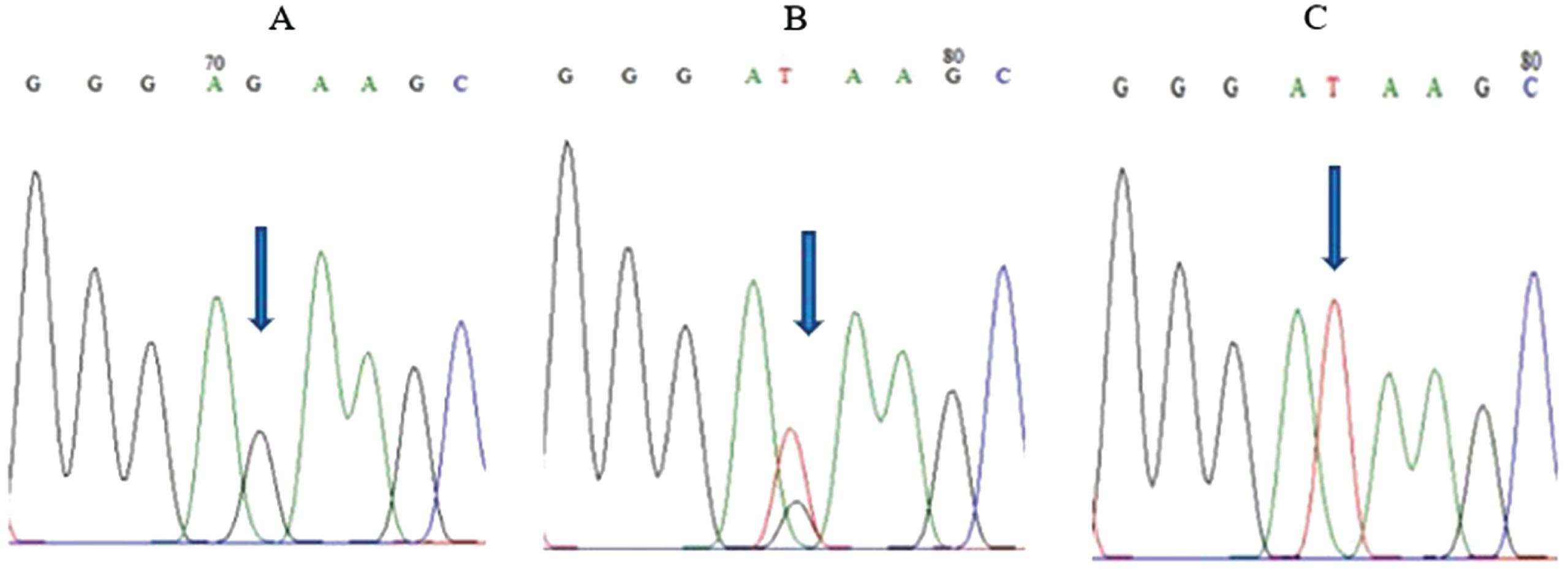 FOXO3 rs2802292 sequencing results. (A) GG homozygous genotype. (B) GT heterozygous genotype. (C) TT homozygous genotype.