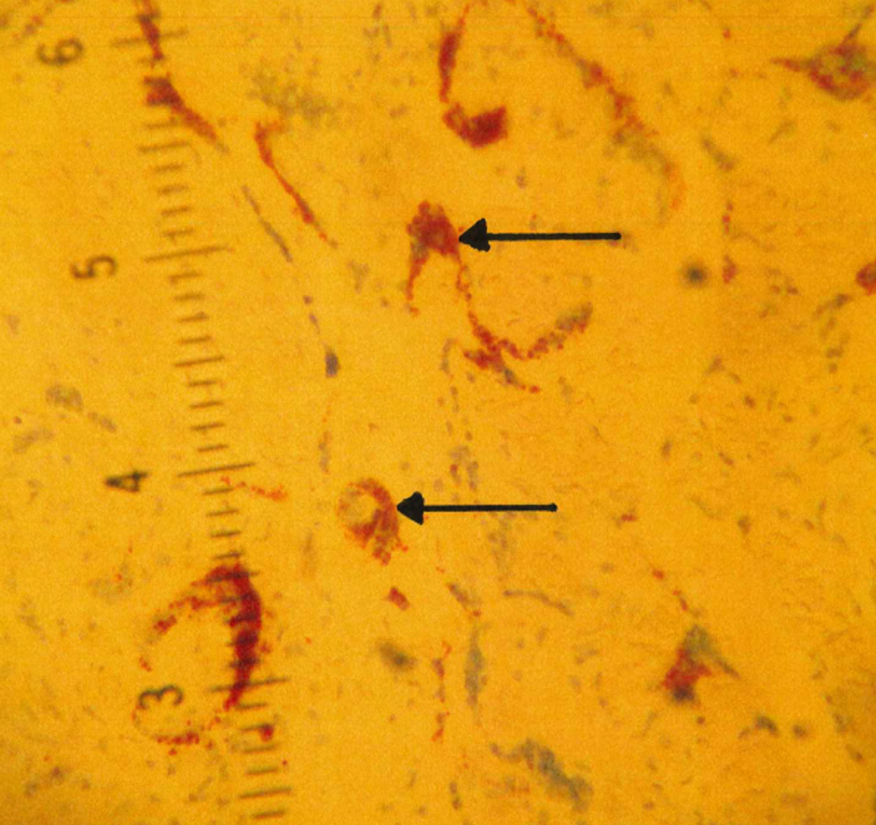 B. Villous trophoblast involvement by COVID-19 demonstrated by SARS-CoV-2 immunohistochemistry staining (arrows).