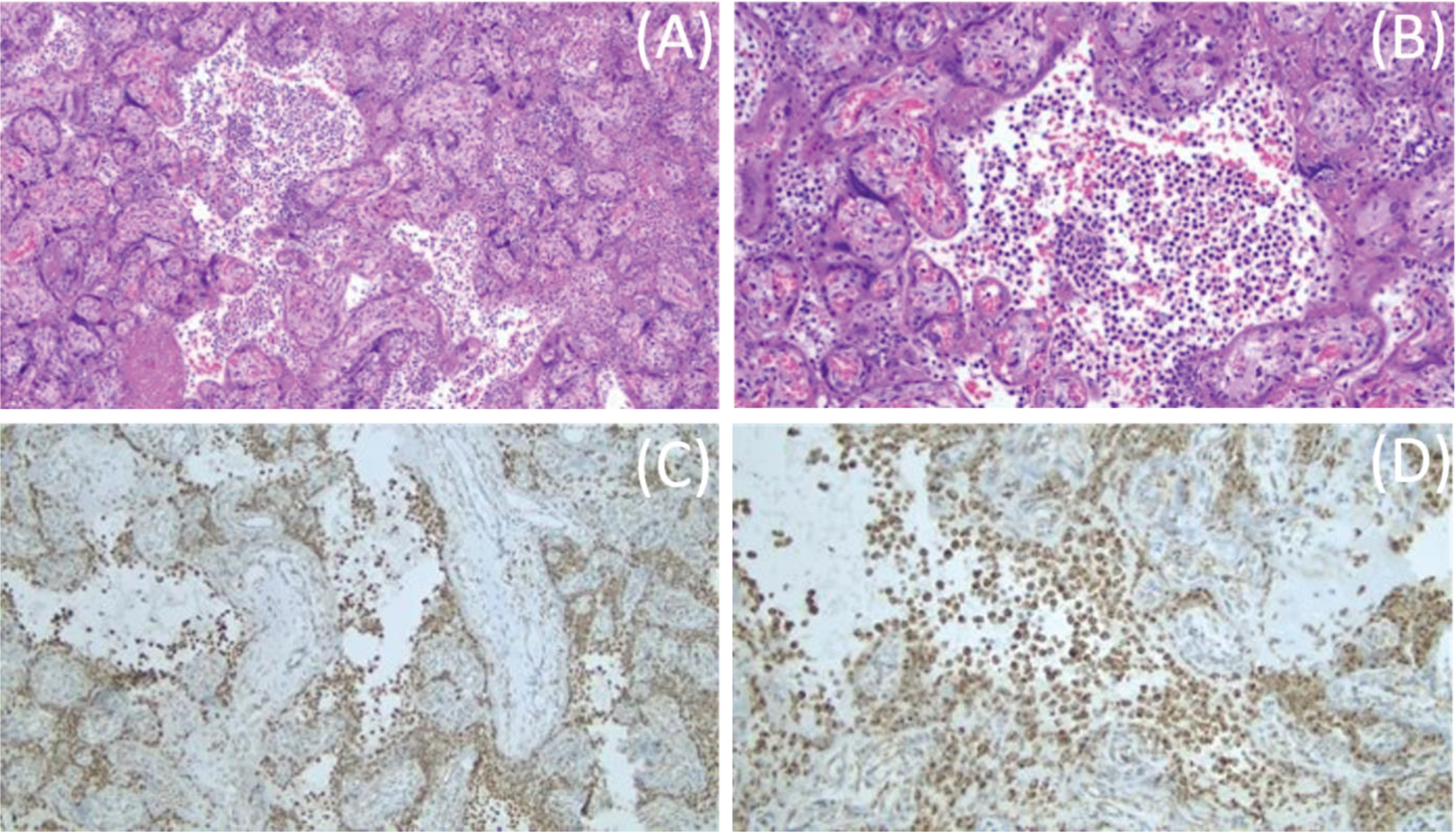 Placental histopathology. Placental hematoxylin and eosin staining showing mononuclear cell inflammation of the intervillous space, chronic histiocytic intervillositis, at 10X (A). Chronic histiocytic intervillositis in the intervillous space at 20X (B). CD68+ histiocytes in the intervillous space at 10X (C). CD68+ histiocytes in the intervillous space at 20X (D).