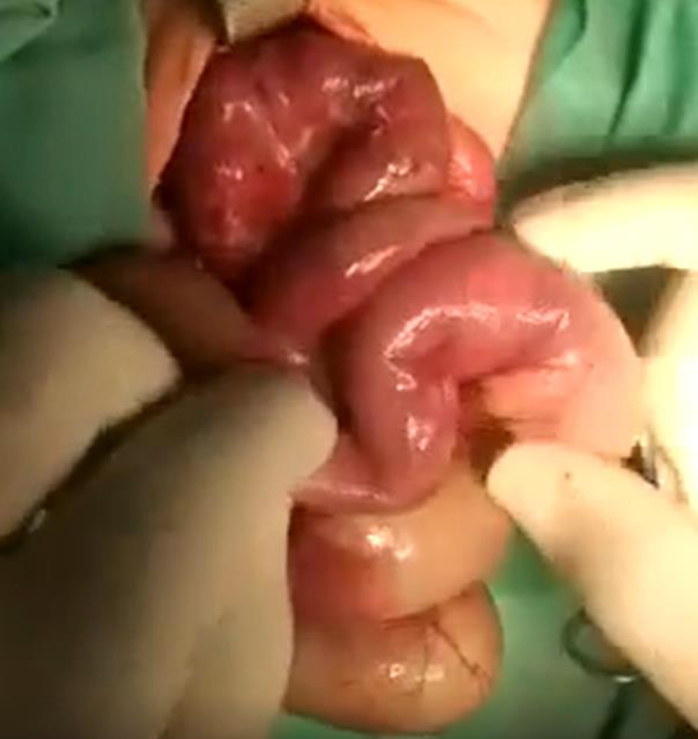 Patient’s intestine on photos during the surgical intervention showing hyperemia, signs of ischemia, and cracks.