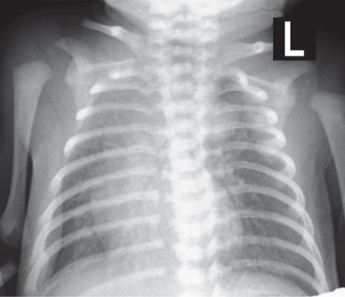 Antero-posterior radiograph of the aneurysm of the ductus arteriosus, with less areation of the right upper lung lobe.