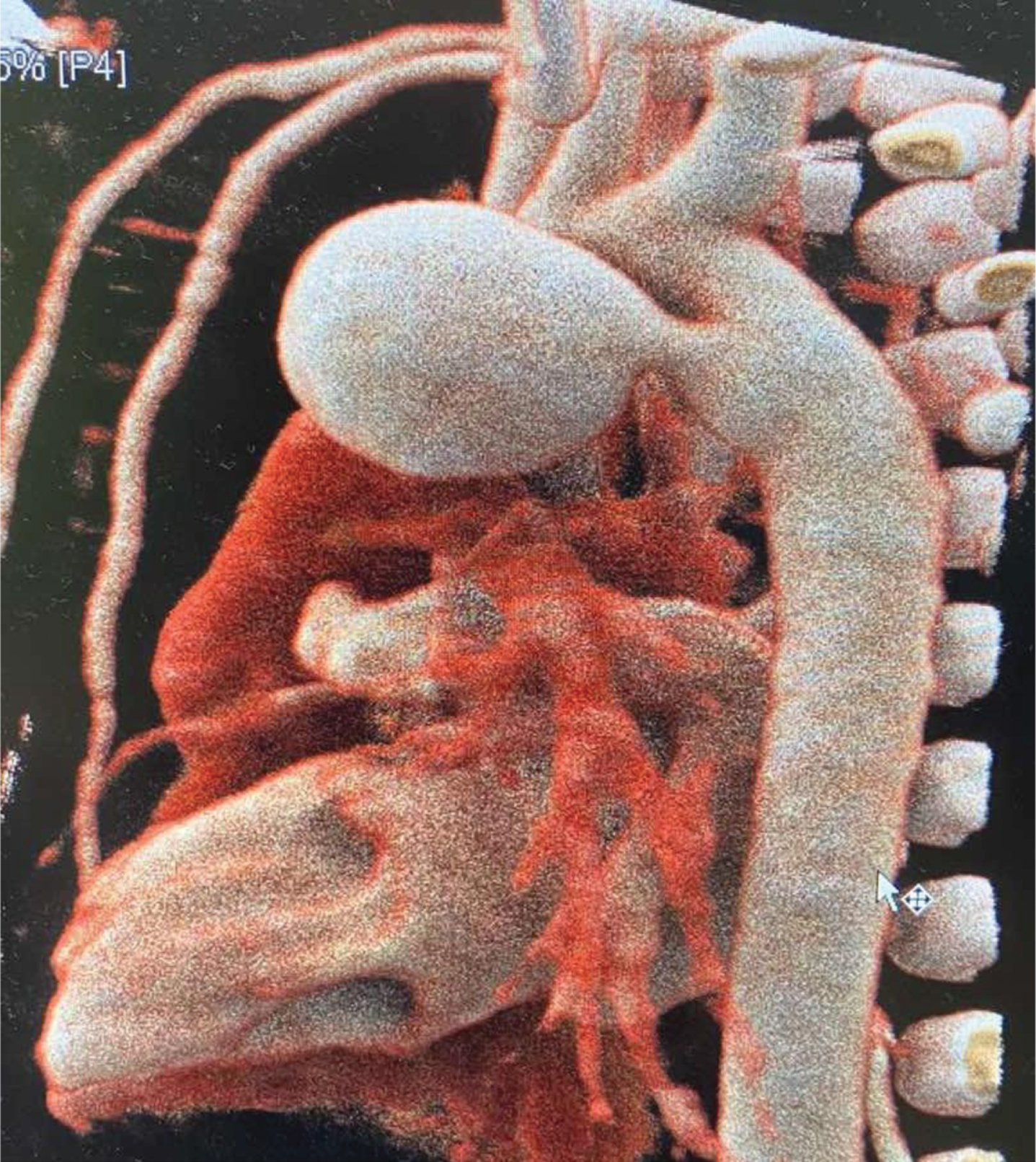 Computed tomographic angiography. Note the striking aneurysmal extension of the PDA 20×14×14 mm without signs of thrombus in the PDA cavity.