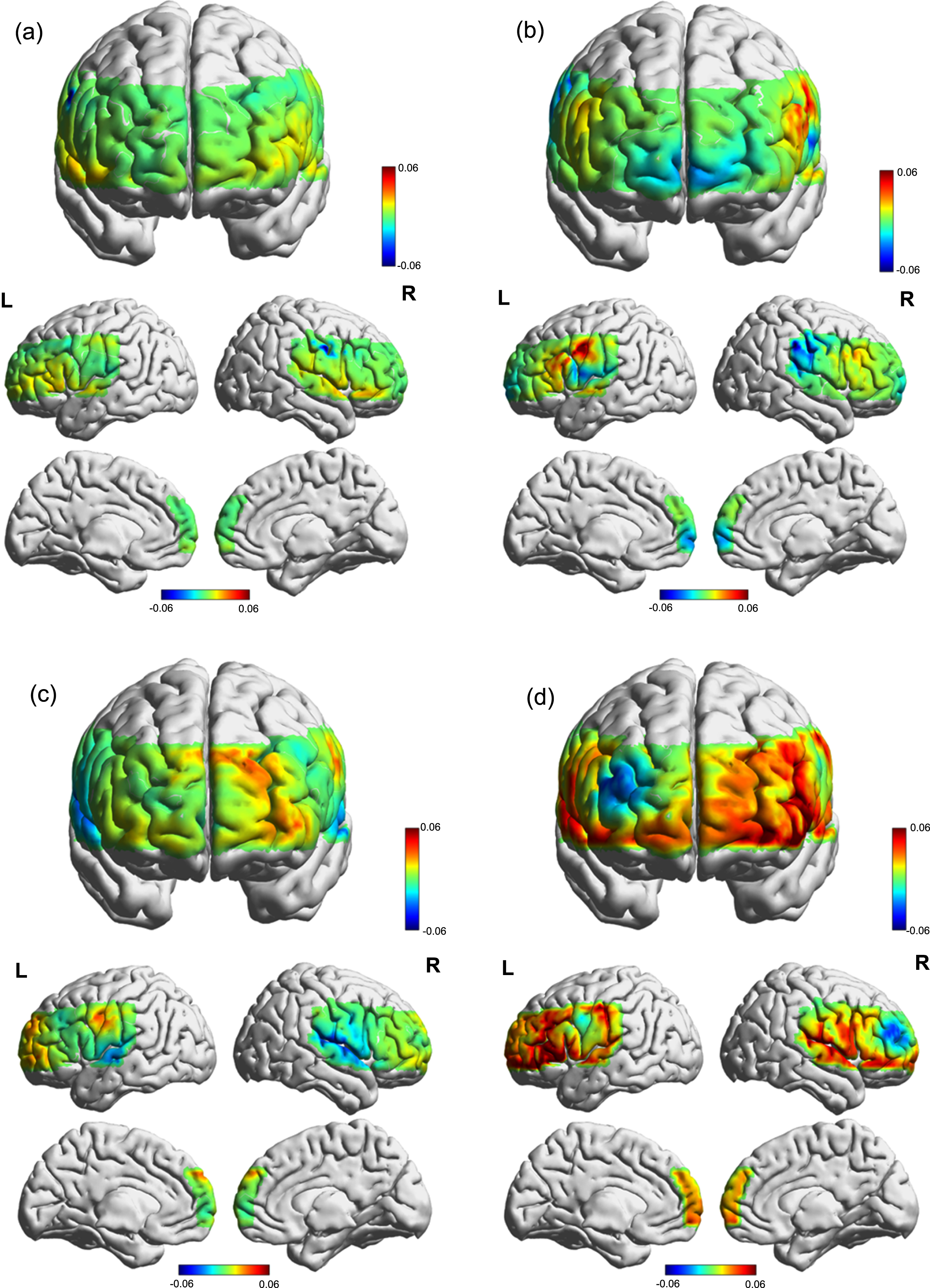 Cortical activation map based on beta values during VFT in different groups. (a) T0 of the control group. (b) T1 of the control group. (c) T0 of the iTBS group. (d) T1 of the iTBS group.