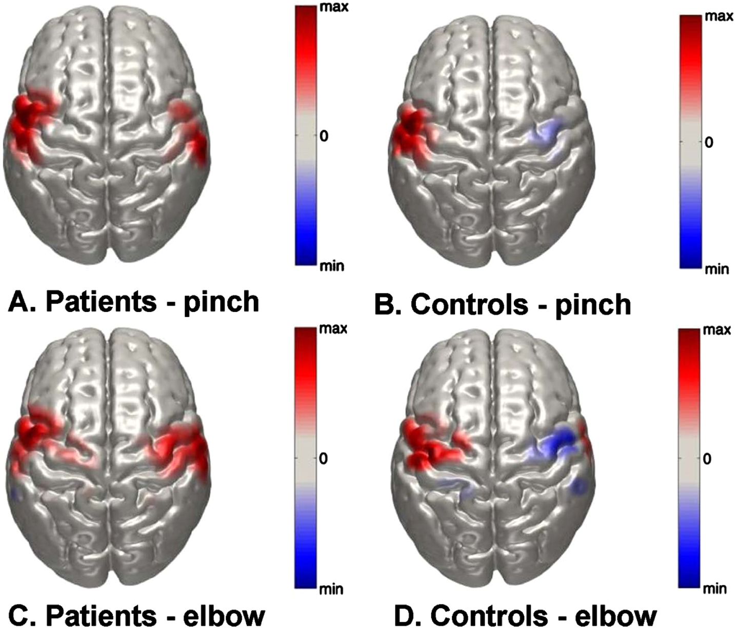 Normalized group-level DOT images of oxy-Hb responses in the right and left hemispheres in response to right sided A) key pinch task in patients; B) elbow-flexion task in patients; C) key pinch task in control subjects and D) elbow-flexion task in control subjects. Scale is arbitrary.
