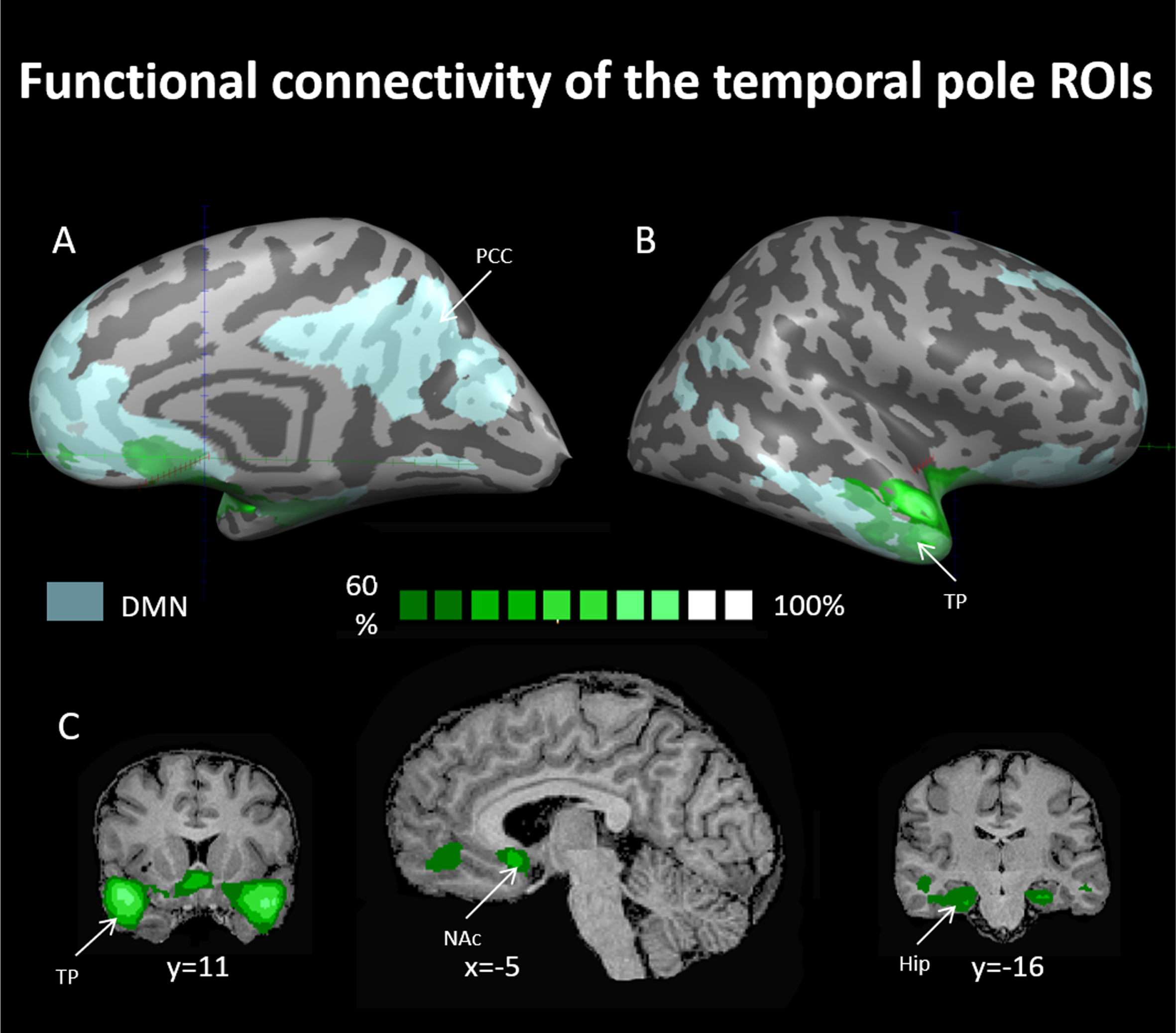 Probability maps for linear correlations of the face movement selective regions in the temporal poles using seed-based analysis. Maps are presented at a threshold of the majority of resting state subjects (60% probability and above –see dark green to bright green scale). ROIs for this analysis were chosen from the progressive muscle relaxation experiment and were used as seeds for computing linear correlations in the data of the resting-state experiment. TP = temporal pole, Hip = hippocampus, PCC = posterior cingulate cortex, NAcc = nucleus accumbens, DMN = default mode network. DMN in light blue as derived from rsFC analysis (see methods).