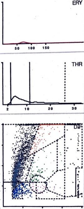 LMNE matrix of a type I with metal debris particles of a 84-year old female patient with knee arthroplasty. The cluster in the NOISE-area. The measured “cell count” was 1970 cells/μL and the percentage of polymorphnuclear neutrophil leukocytes (PMN) was 23.4%.
