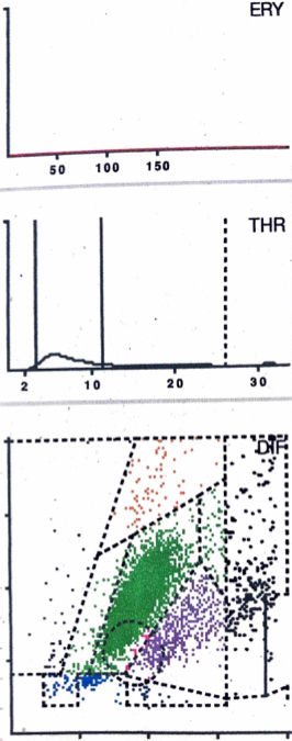 LMNE matrix of a type II (infection type) with a cluster of data points in the area of the neutrophil leukocytes and no peak in the erythrocyte field in a 57-year old patient with a late periprosthetic joint infection of a total knee arthroplasty. The measured cell count was 9840 cells/μL and 89.4% PMN.